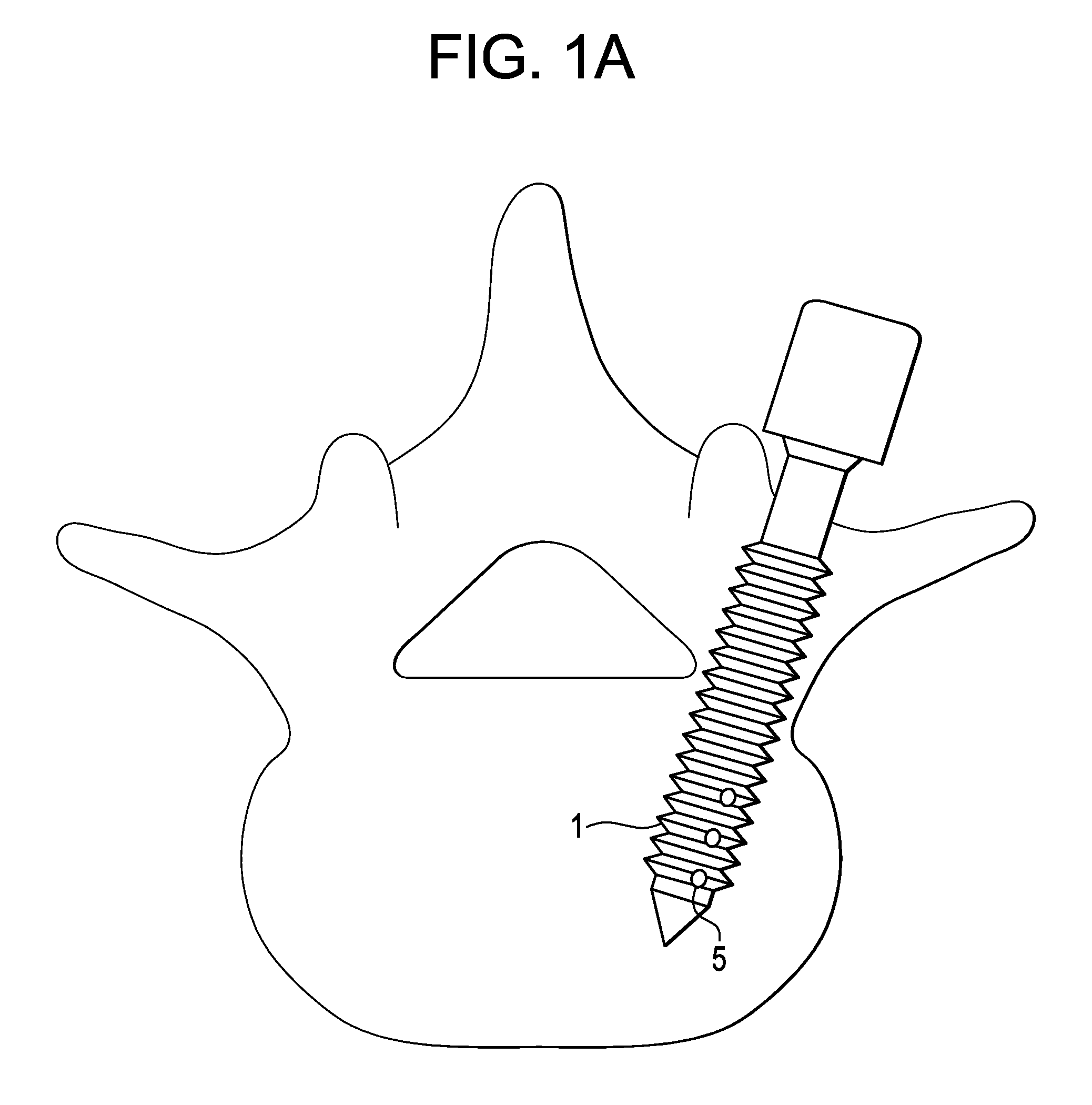 Methods and Devices for Correcting Spinal Deformity With Pharmaceutical-Eluting Pedicle Screws