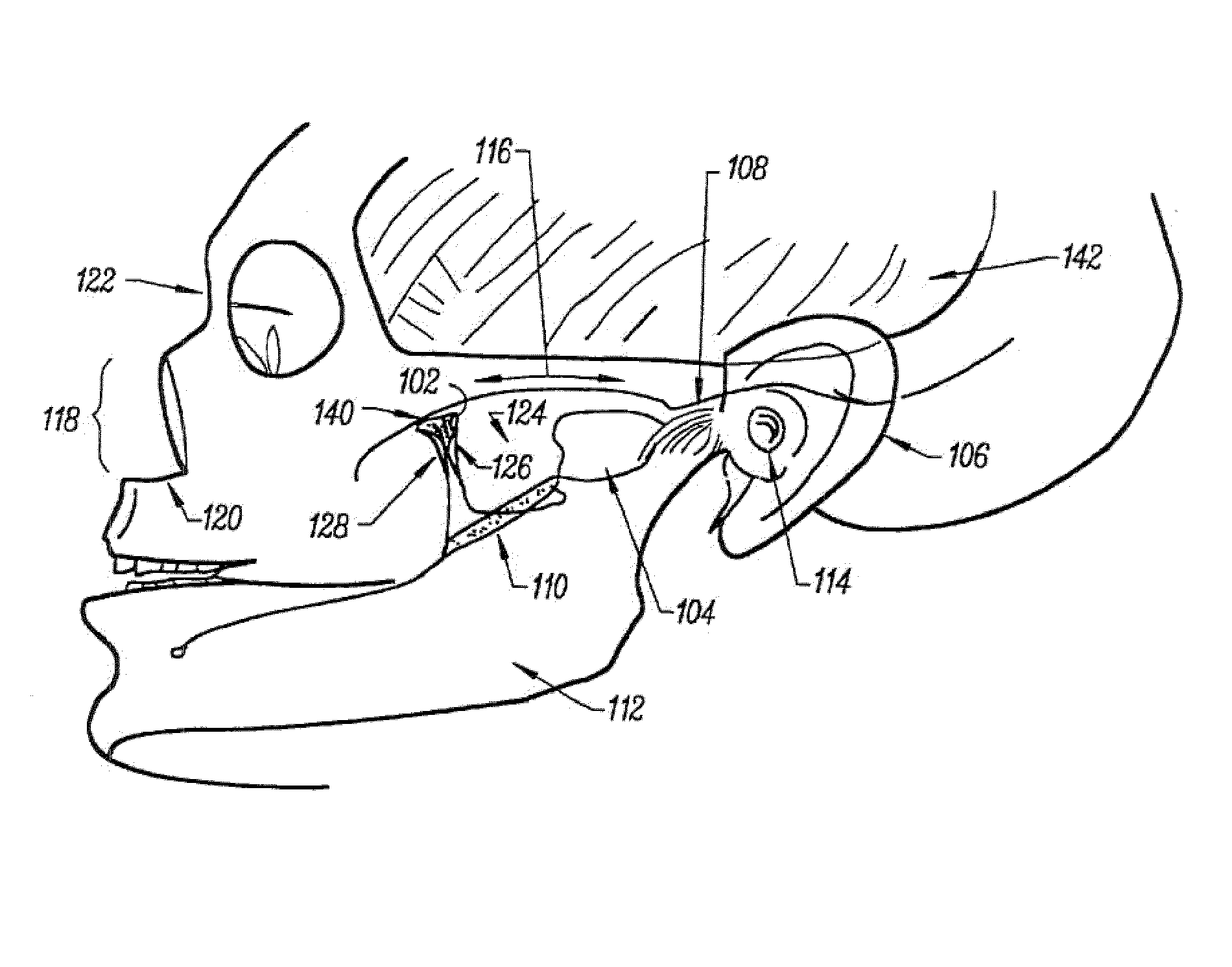 Stimulation method for the sphenopalatine ganglia, sphenopalatine nerve, or vidian nerve for treatment of medical conditions