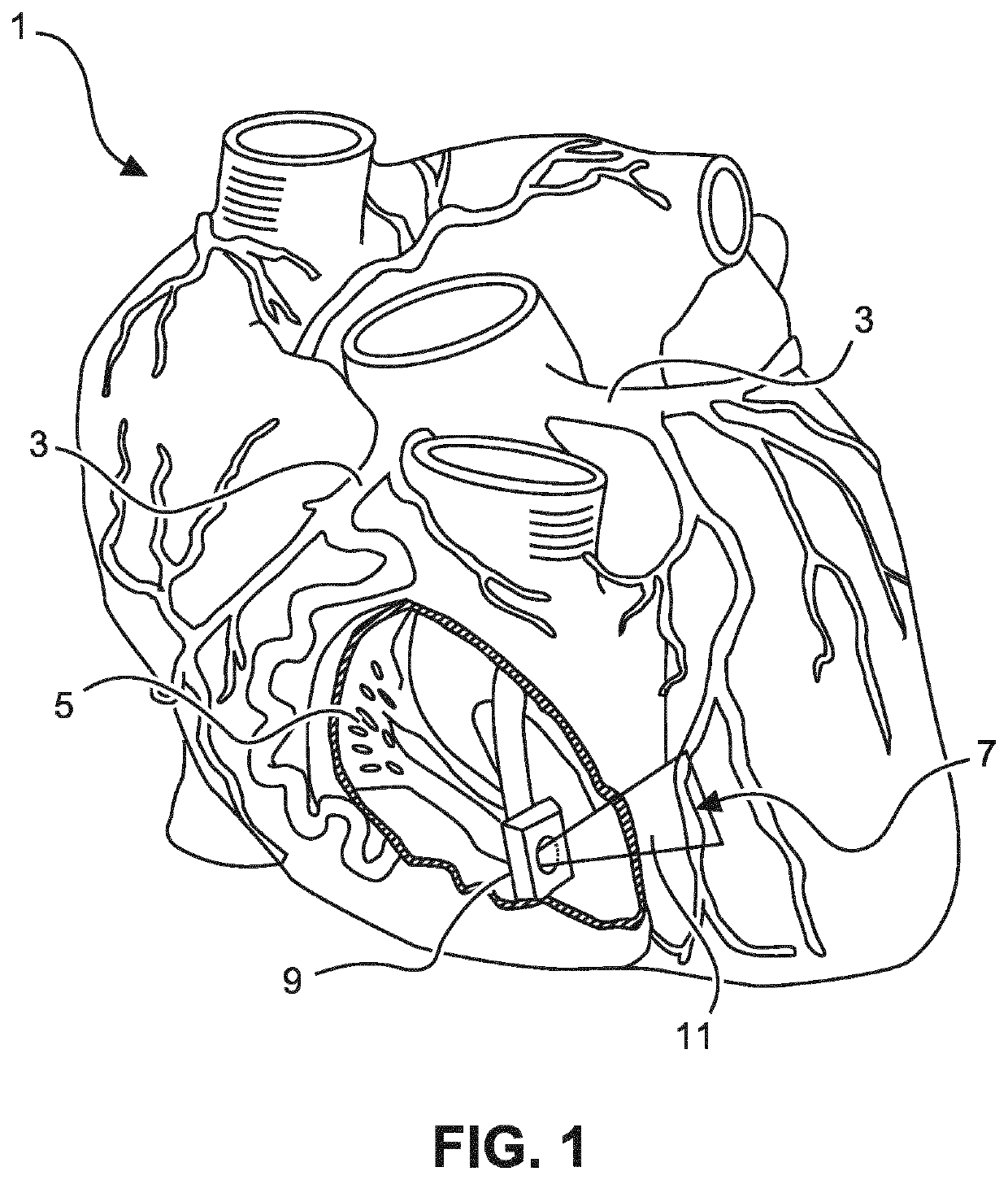 Coronary circulation using intra-cardiac echo