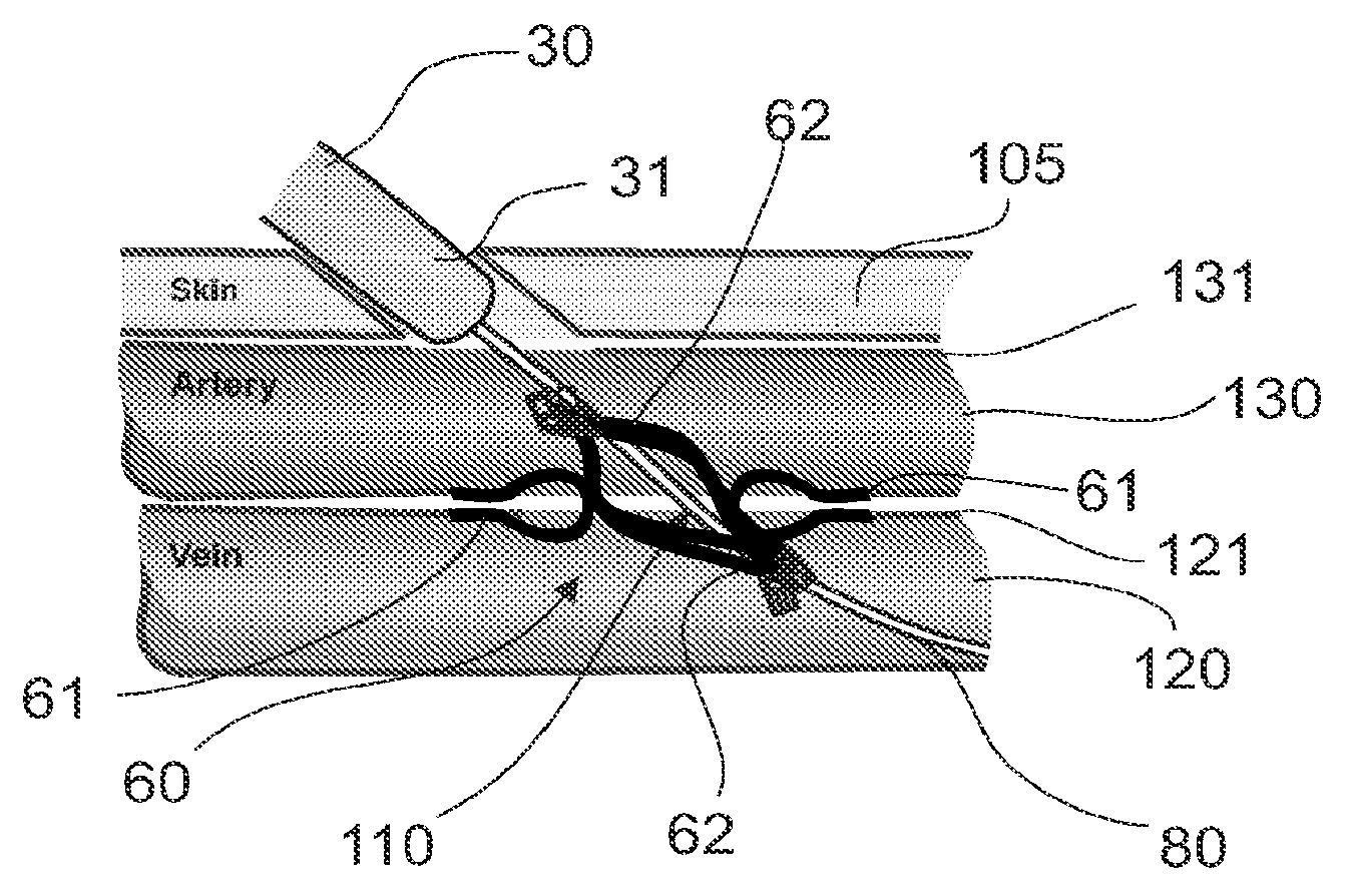 Devices, systems and methods for creation of a peripherally located fistula