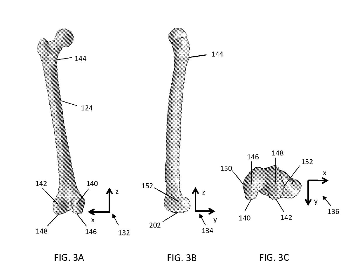 Automated arthroplasty planning