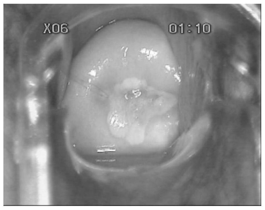 A device for detecting cervical cancer based on colposcopy images