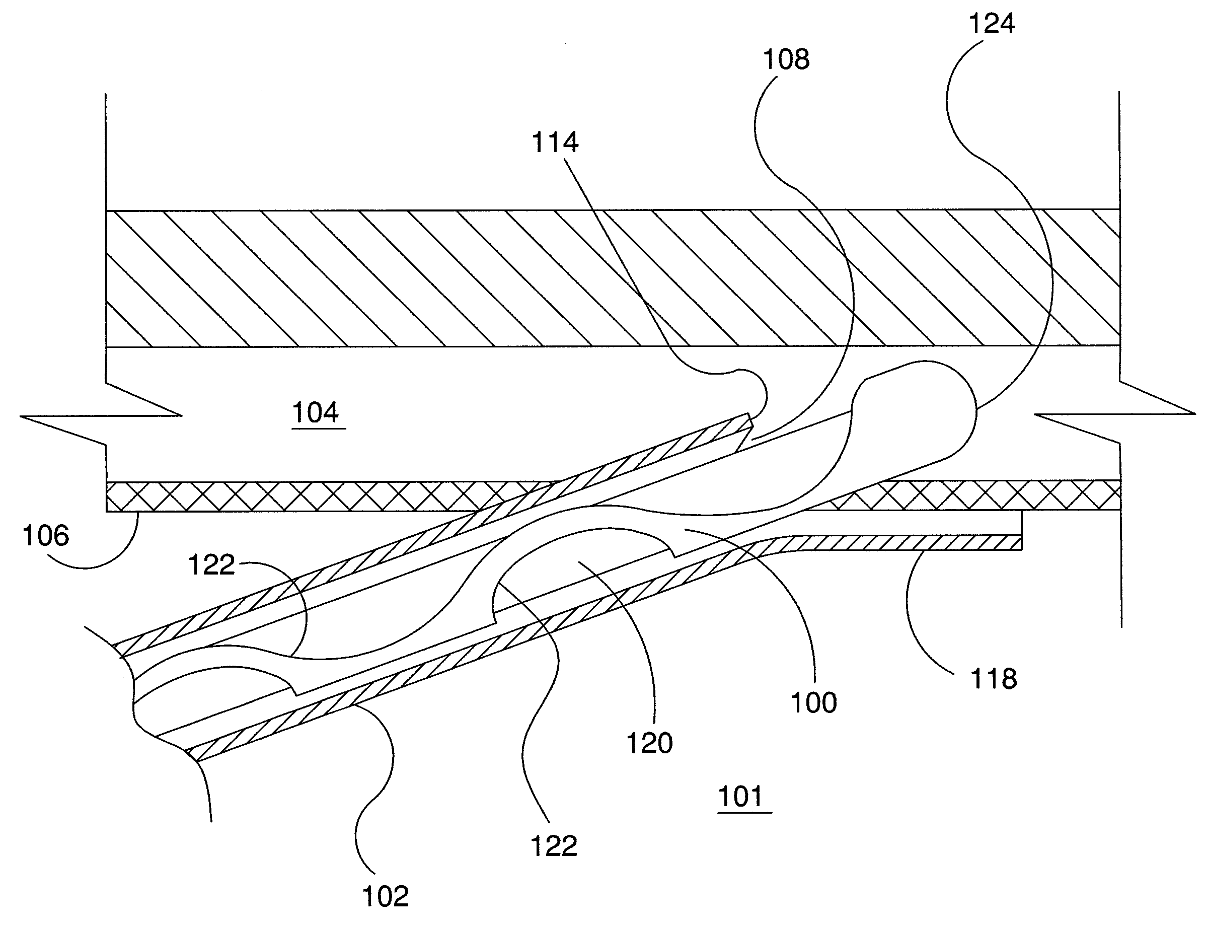 Ocular Implant Delivery System and Method