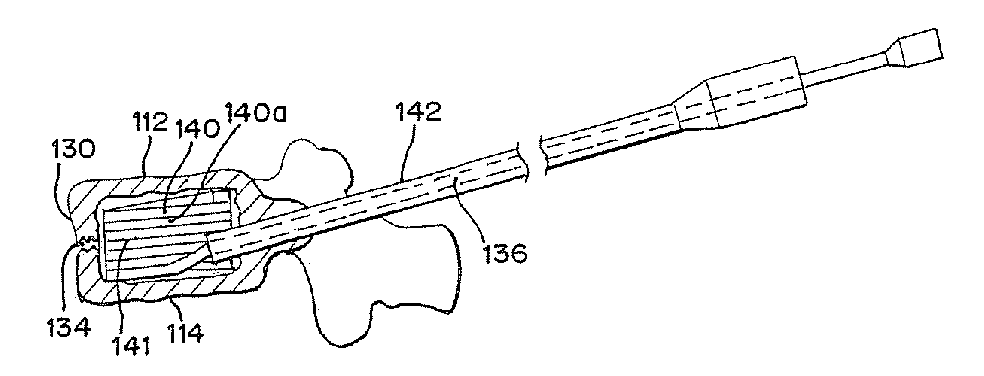 Spinal Tissue Distraction Devices