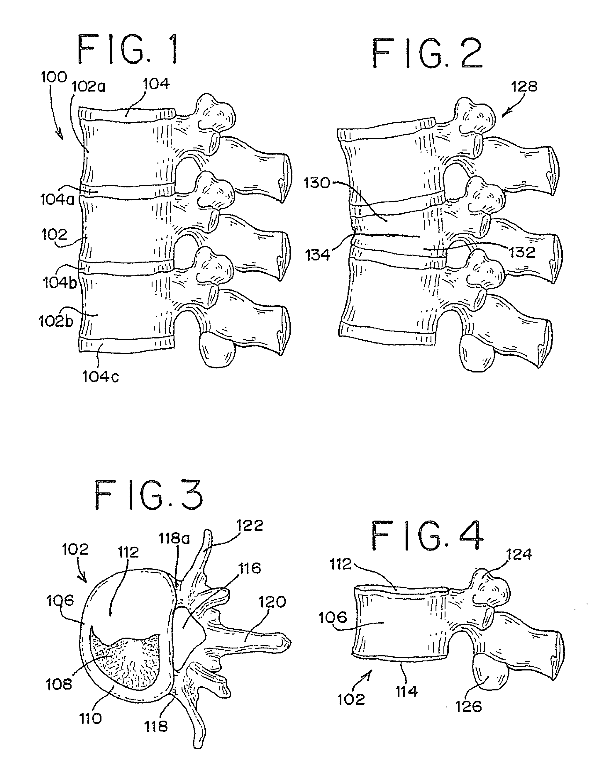 Spinal Tissue Distraction Devices