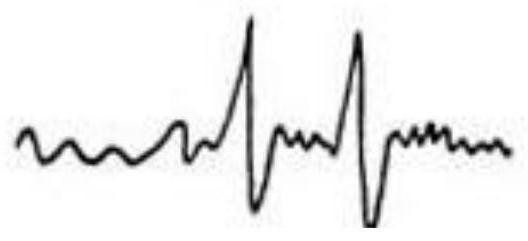 Epilepsy prediction system and method based on electrical impedance imaging and EEG signals