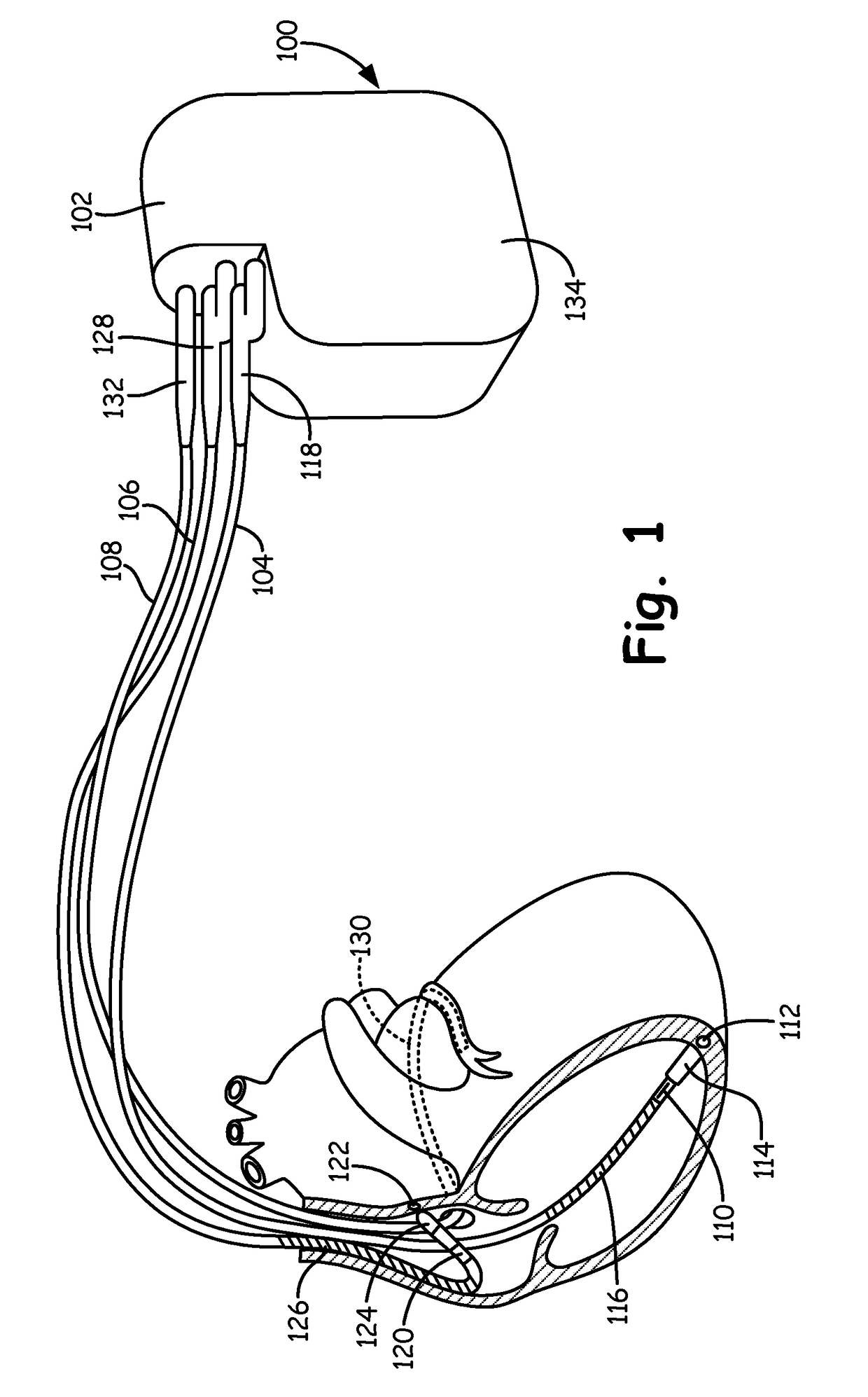 Method and apparatus for verifying bradycardia/asystole episodes via detection of under-sensed events