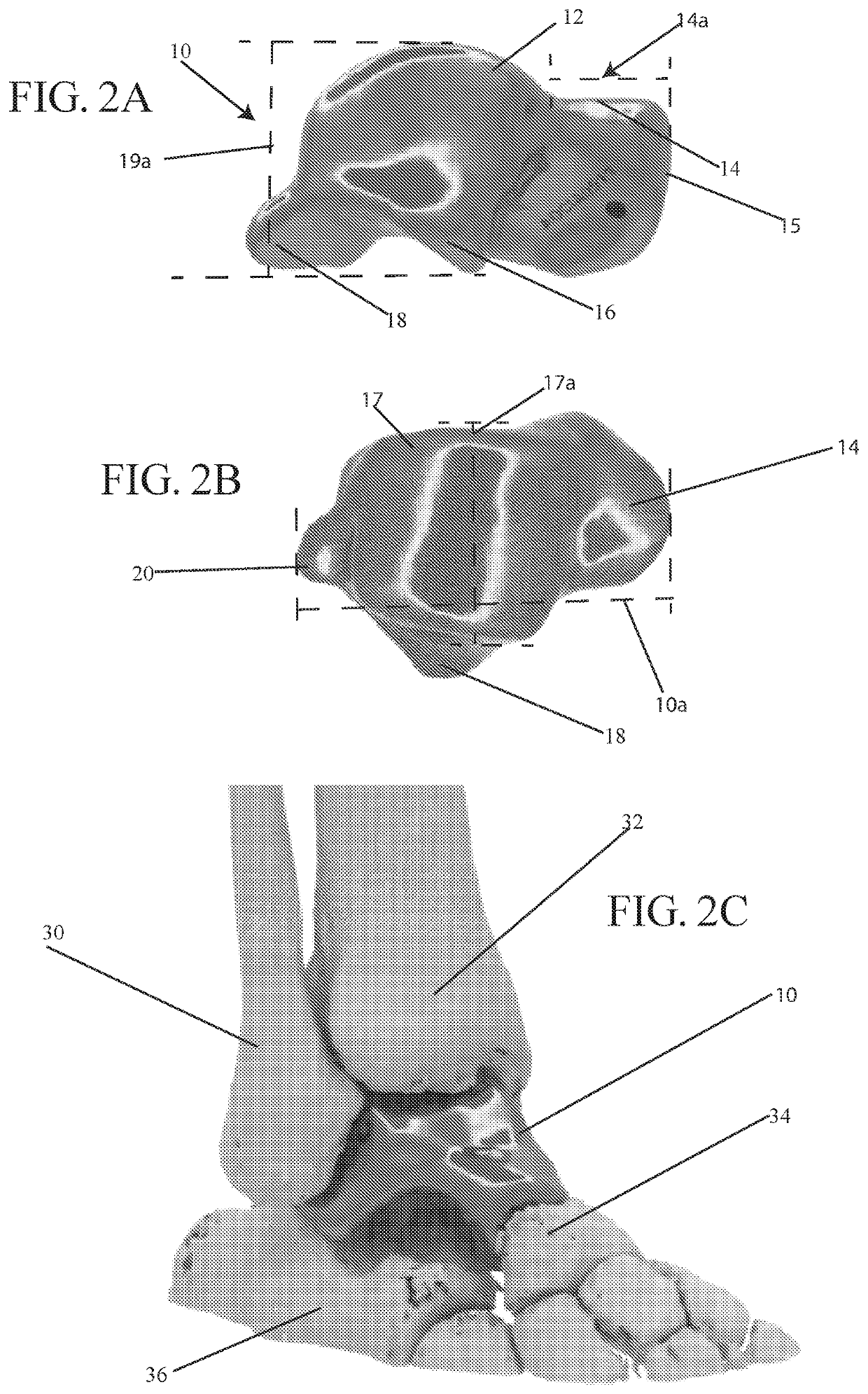 Talus formation and implantation method