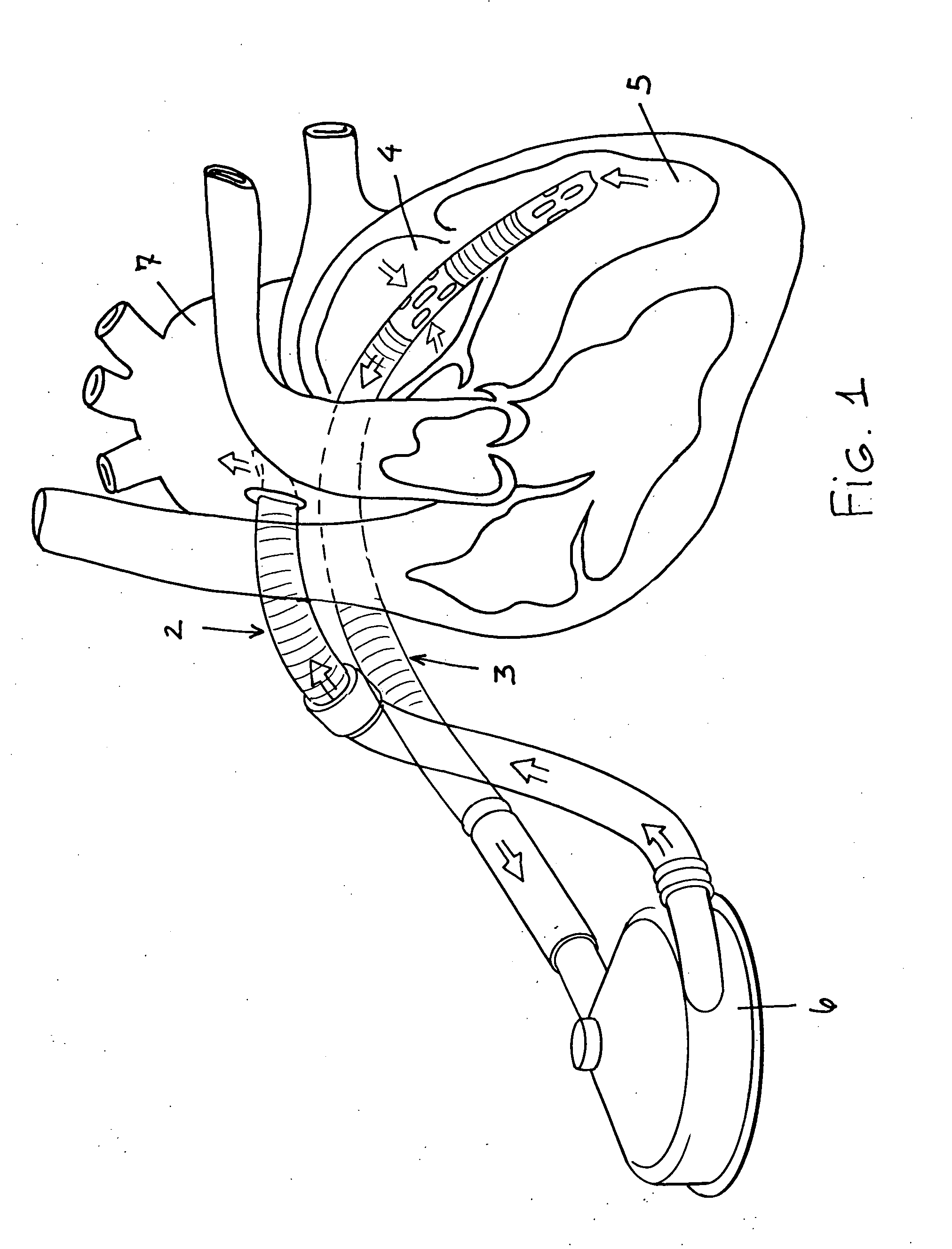 Apparatus for performing myocardial revascularization in a beating heart and left ventricular assistance condition