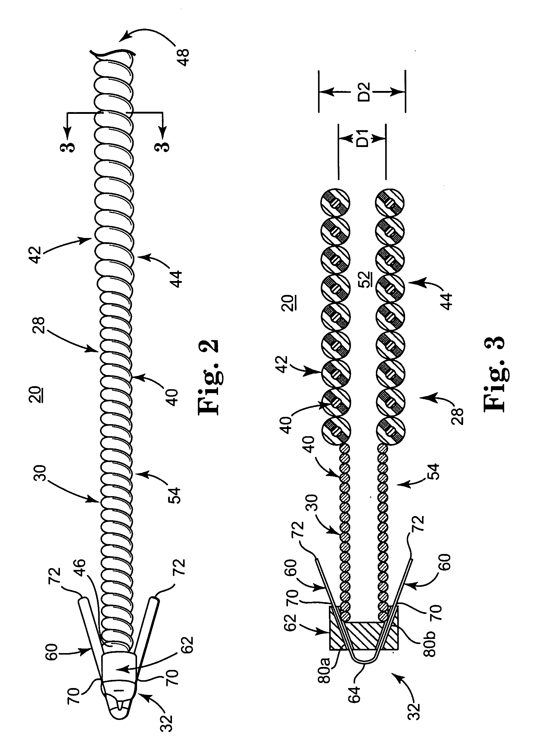 Implantable medical electrical stimulation lead with distal fixation and method