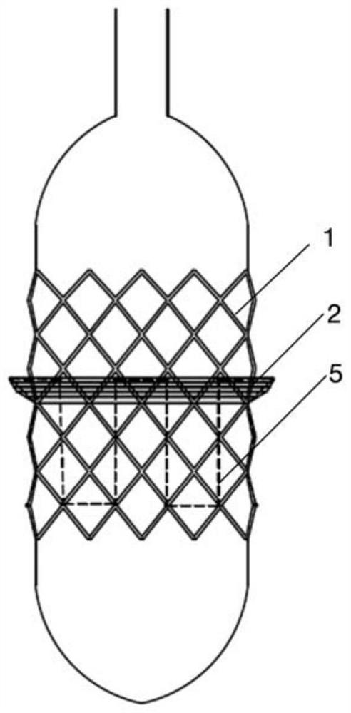 Balloon expansion type interventional valve stent with folding wingspan skirt