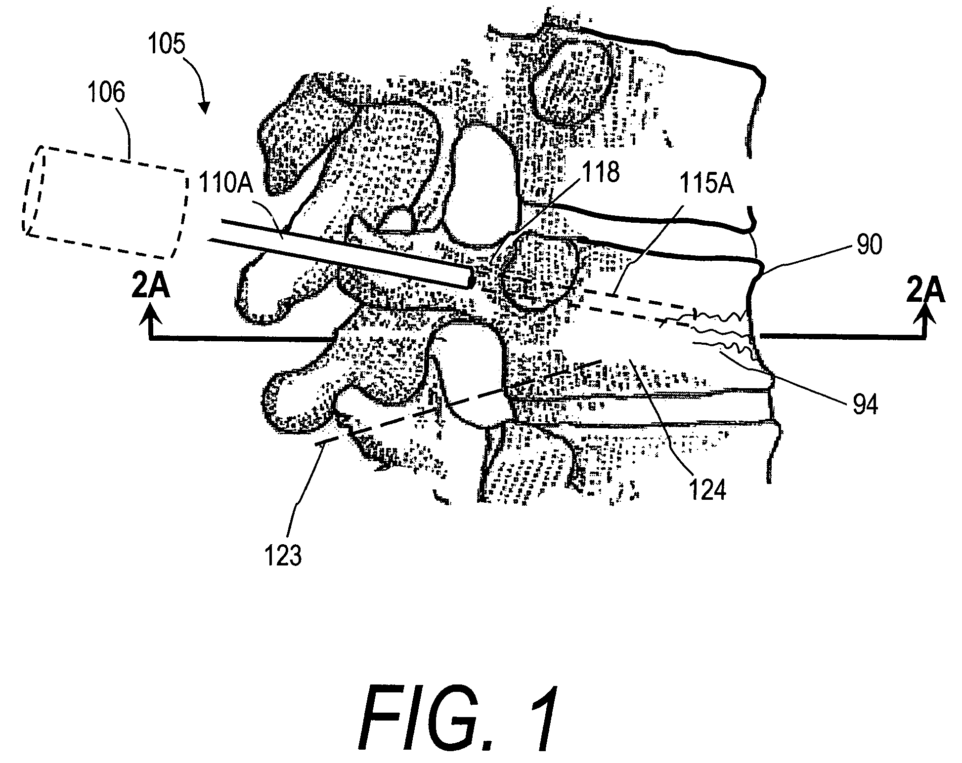 Bone treatment systems and methods