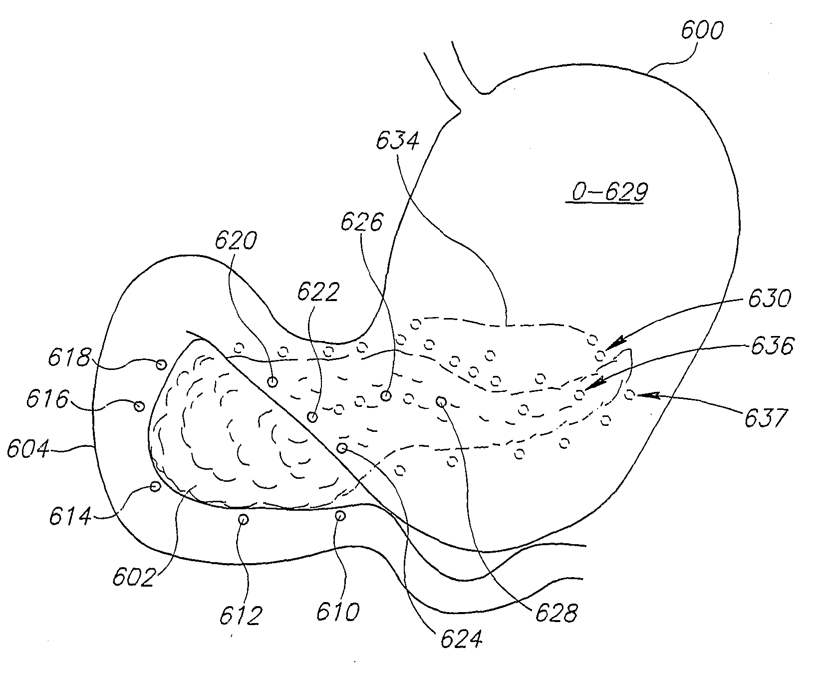 Gastrointestinal Methods And Apparatus For Use In Treating Disorders And Controlling Blood Sugar