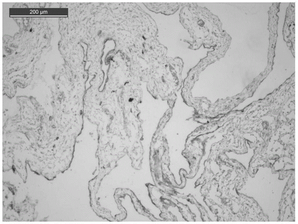 Application of pingyangmycin combined with sodium hyaluronate in drug for treating lymphatic malformation