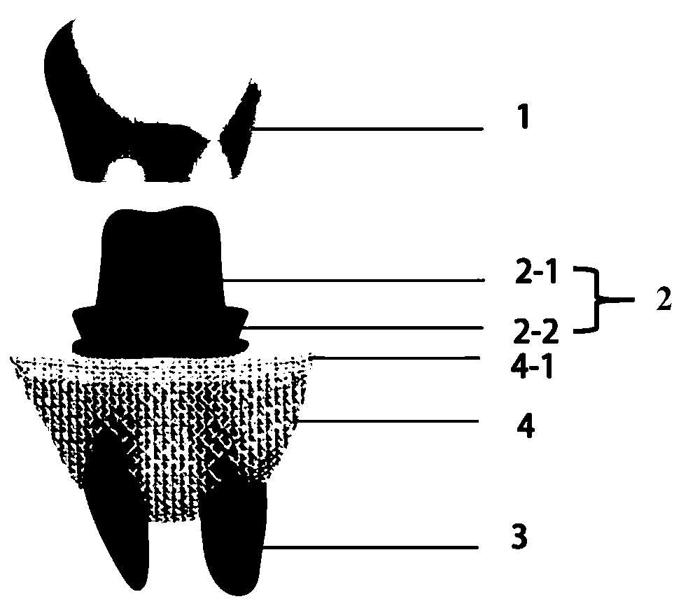 Personalized bionic implant for synchronously repairing tooth and peripheral alveolar bone defects and forming method thereof