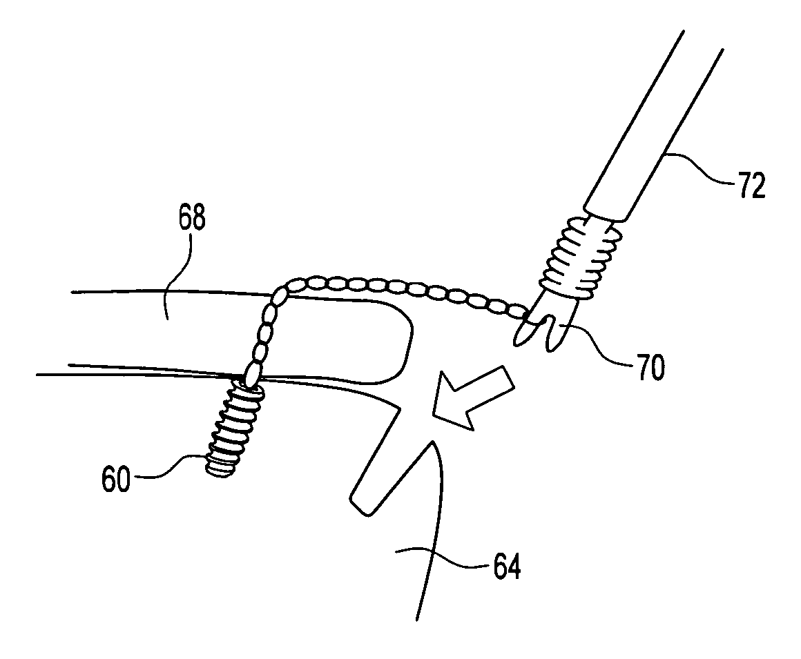 Looped high strength suture chain for knotless fixation