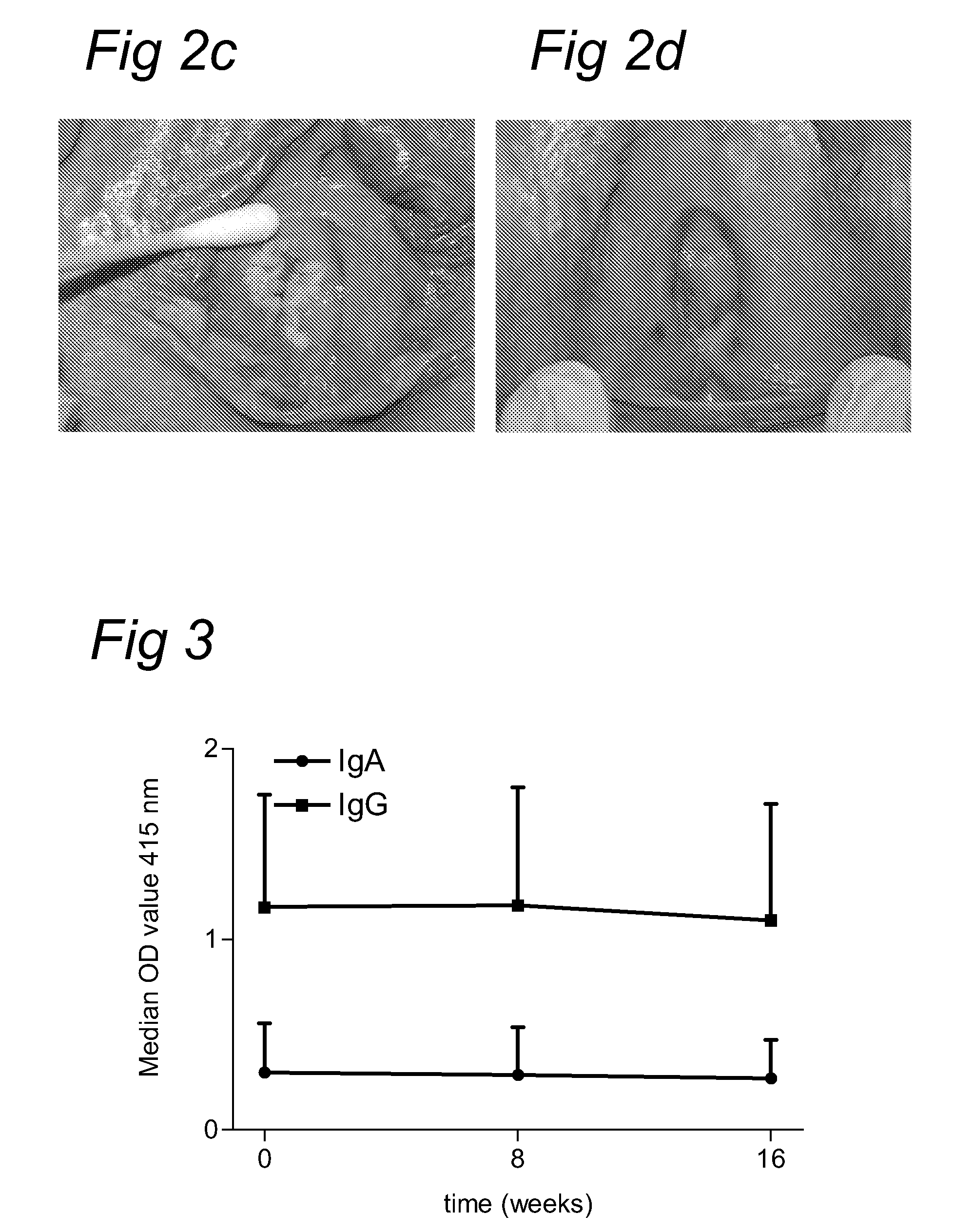 Methods and means for the treatment of HPV induced intraepithelial neoplasia