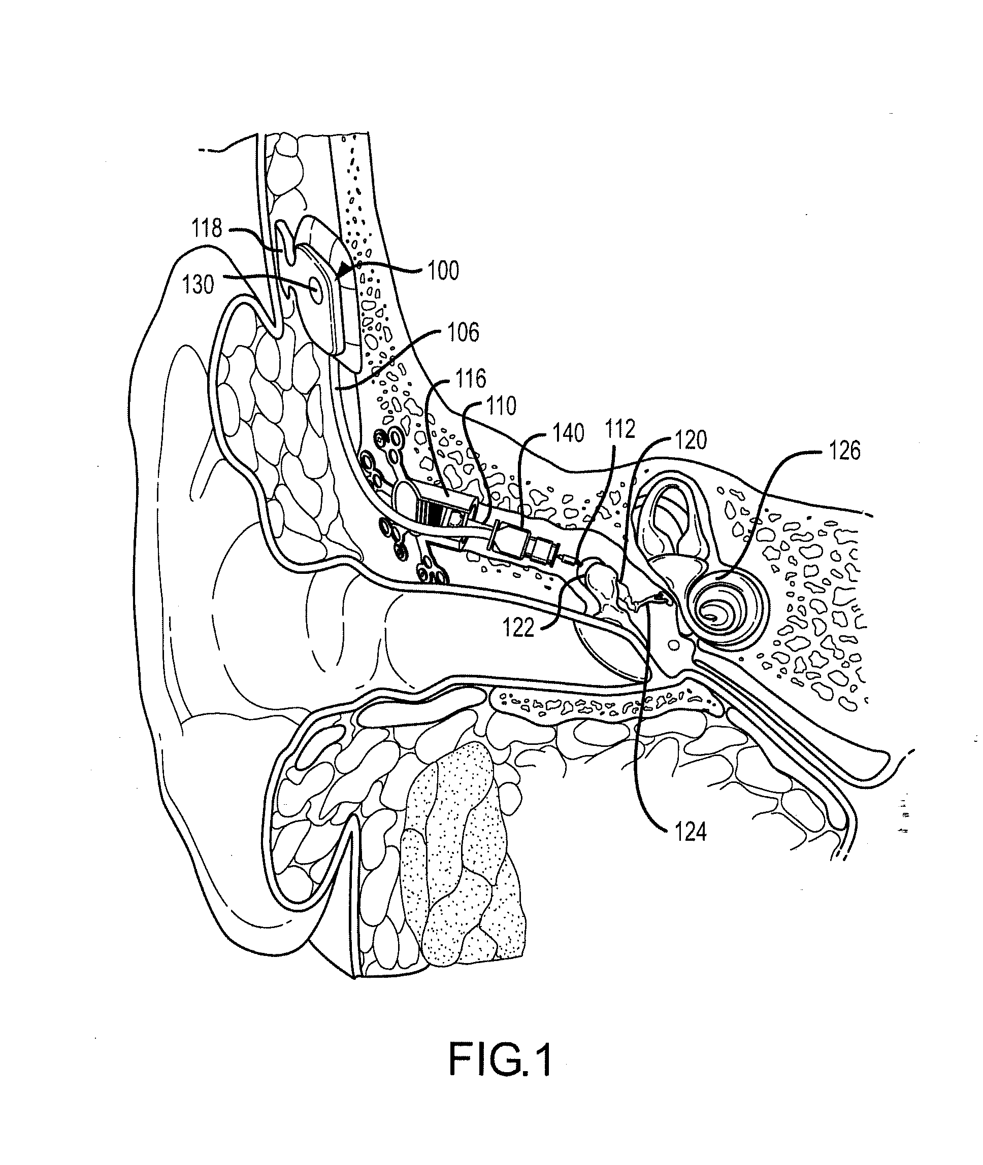 Compressive coupling of an implantable hearing aid actuator to an auditory component