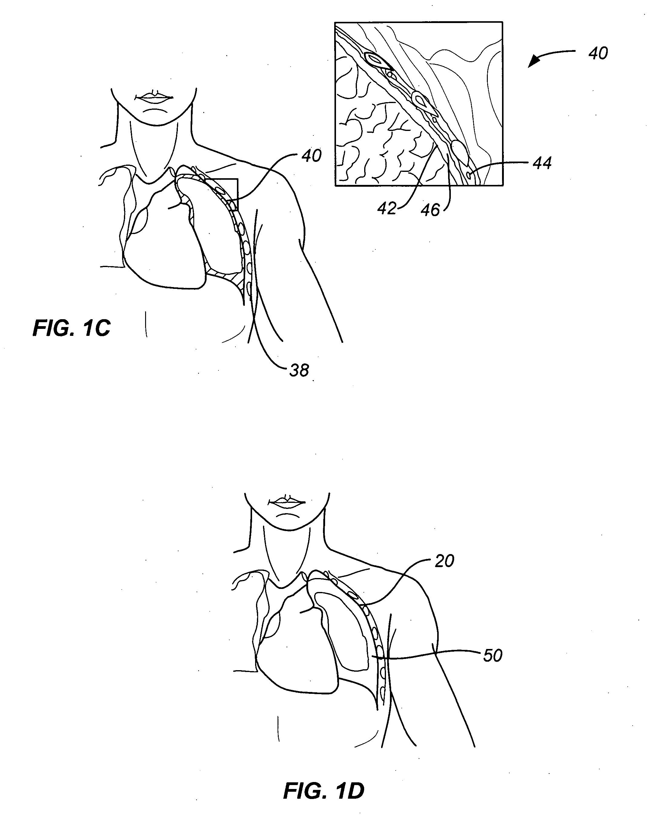 Steerable device for accessing a target site and methods