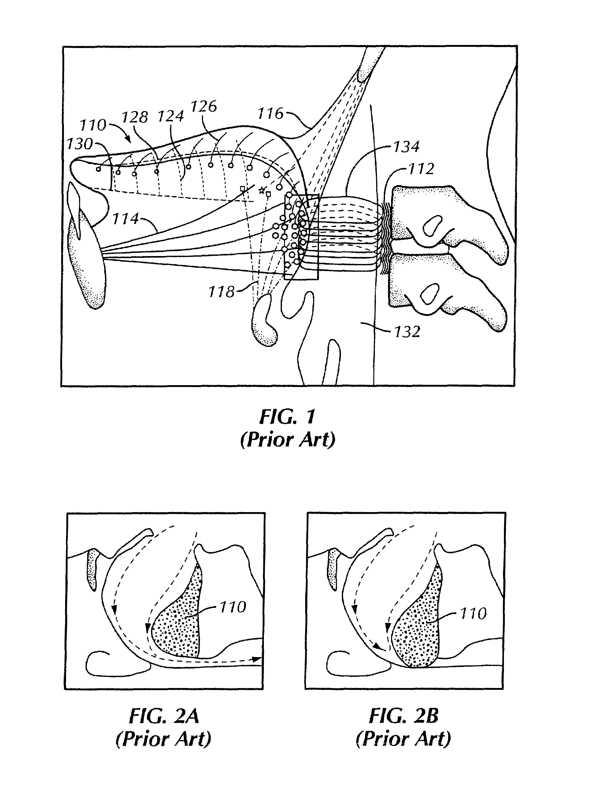 Method of Stimulating a Hypoglossal Nerve for Controlling the Position of a Patient's Tongue