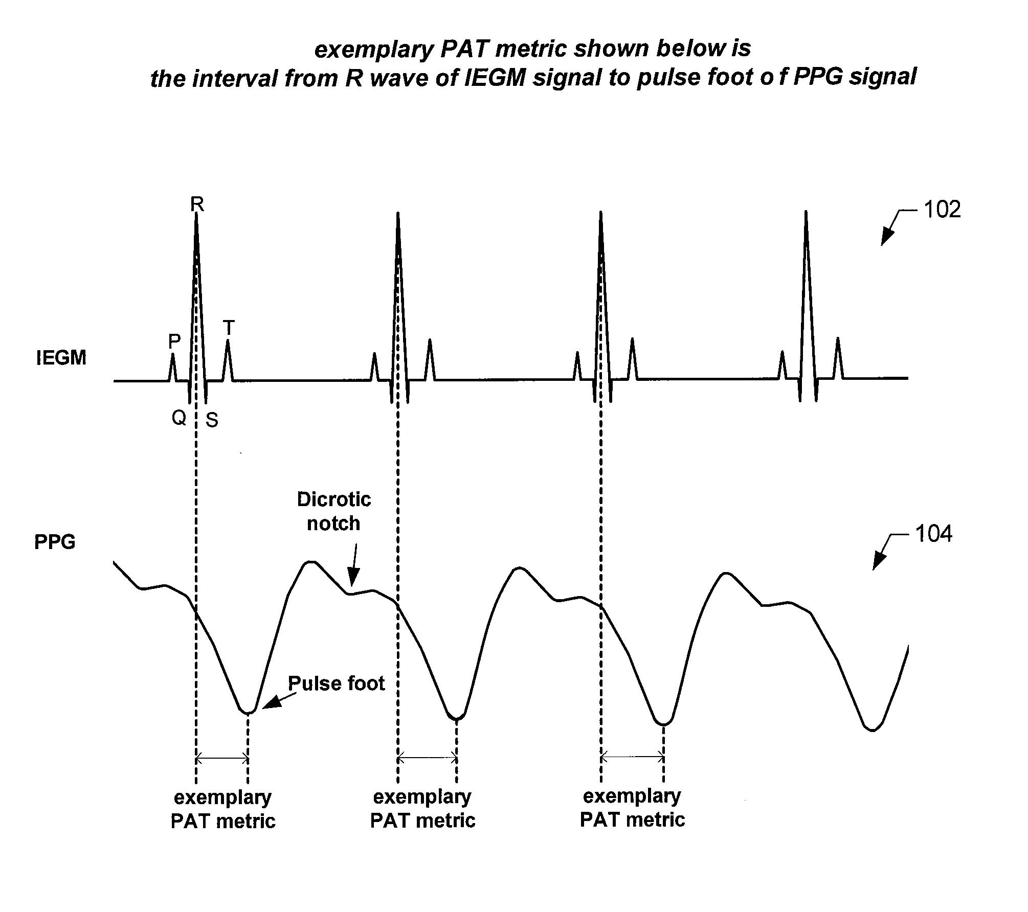Implantable systems and methods for use therewith for monitoring and modifying arterial blood pressure without requiring an intravascular pressure transducer