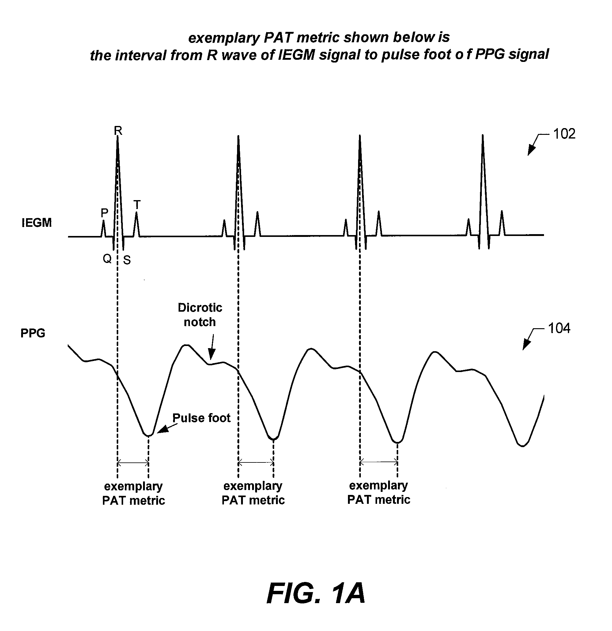 Implantable systems and methods for use therewith for monitoring and modifying arterial blood pressure without requiring an intravascular pressure transducer