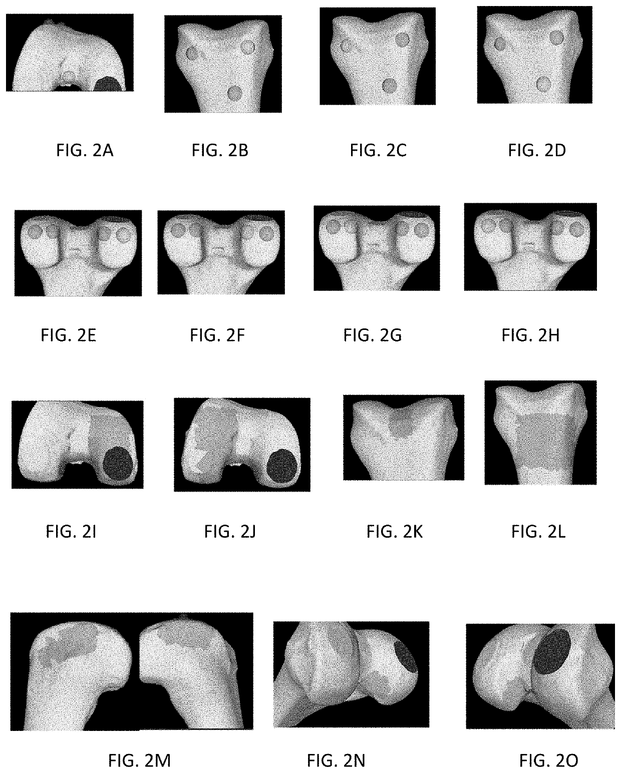 Bone registration methods for robotic surgical procedures