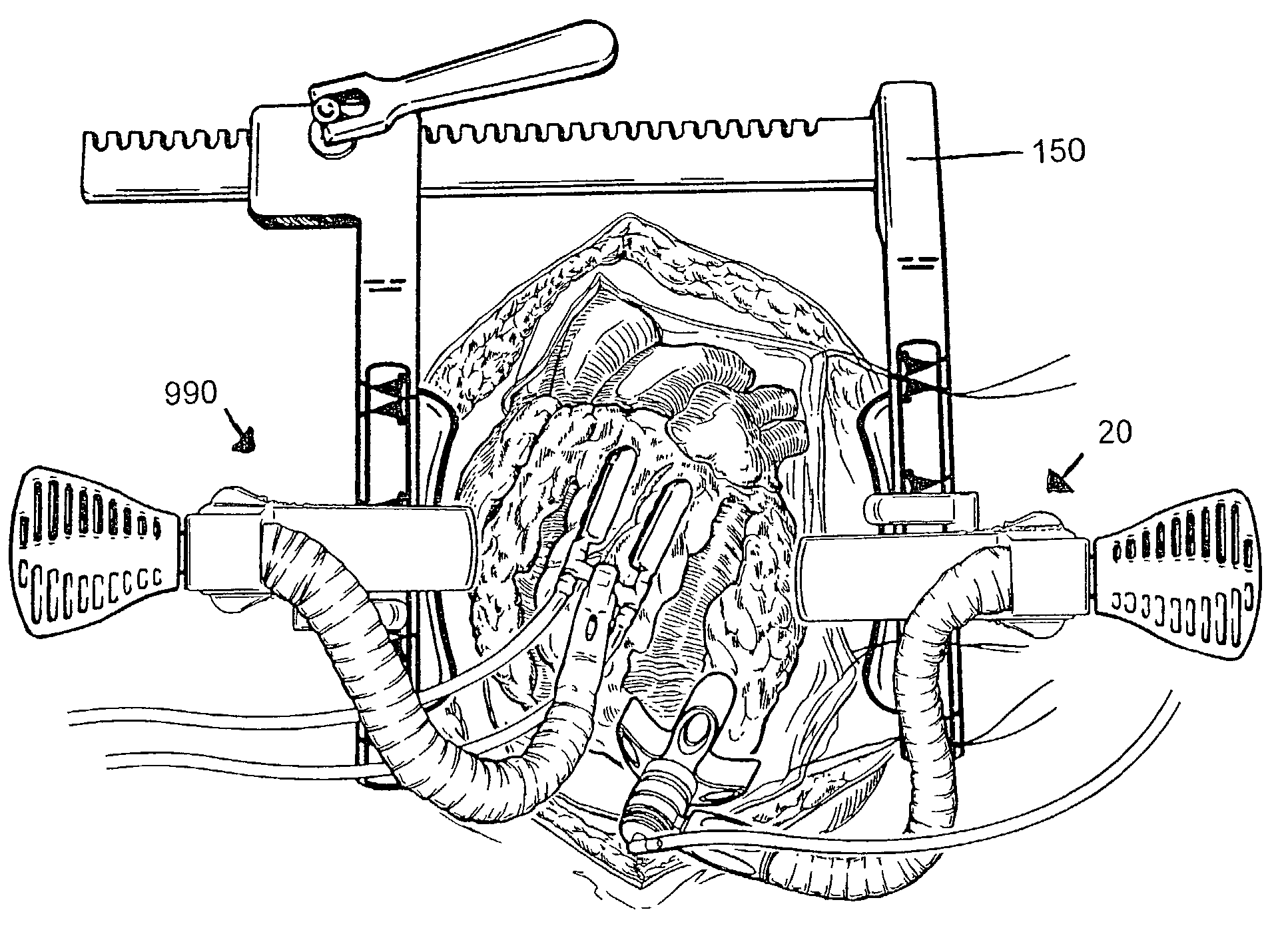 Method and system for organ positioning and stabilization