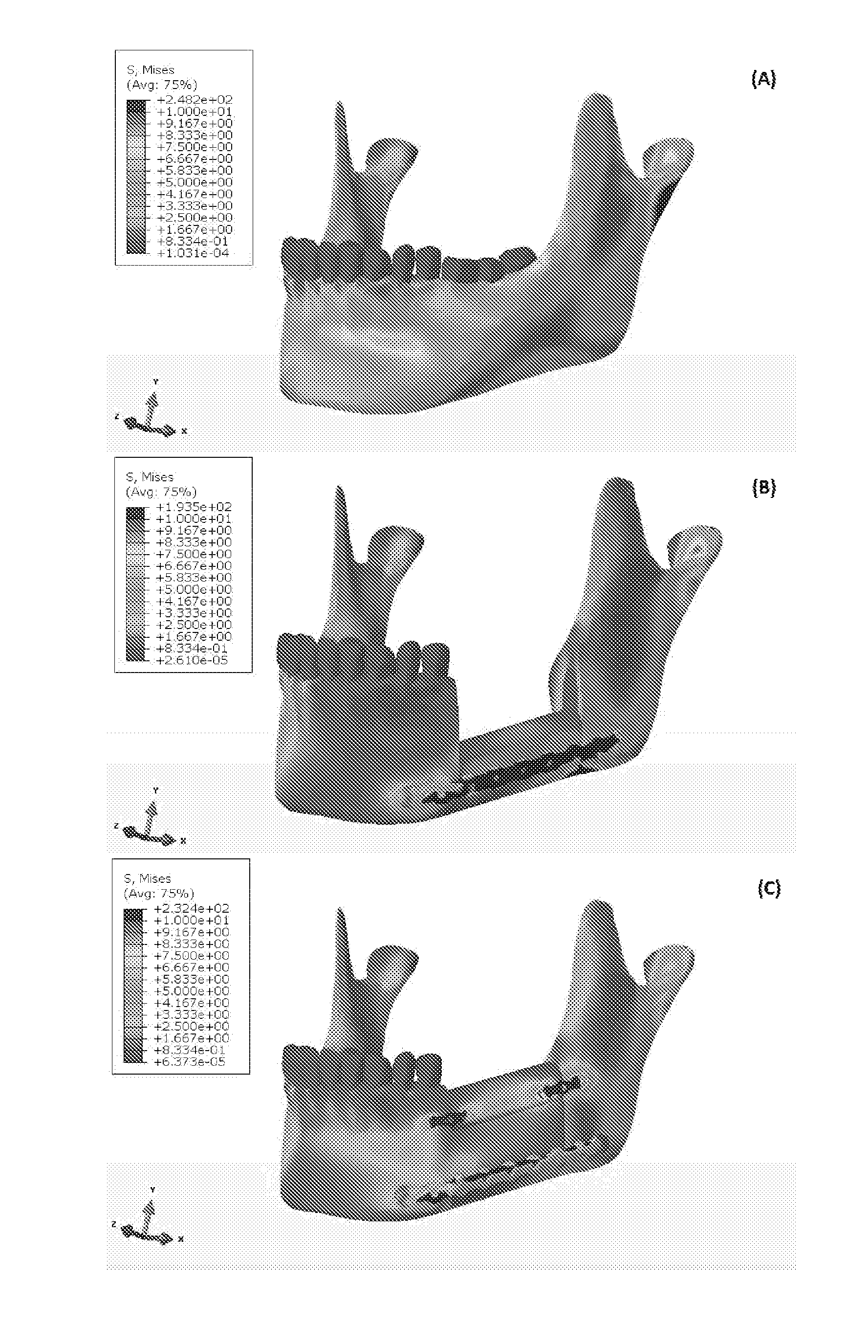 Methods, devices, and manufacture of the devices for musculoskeletal reconstructive surgery