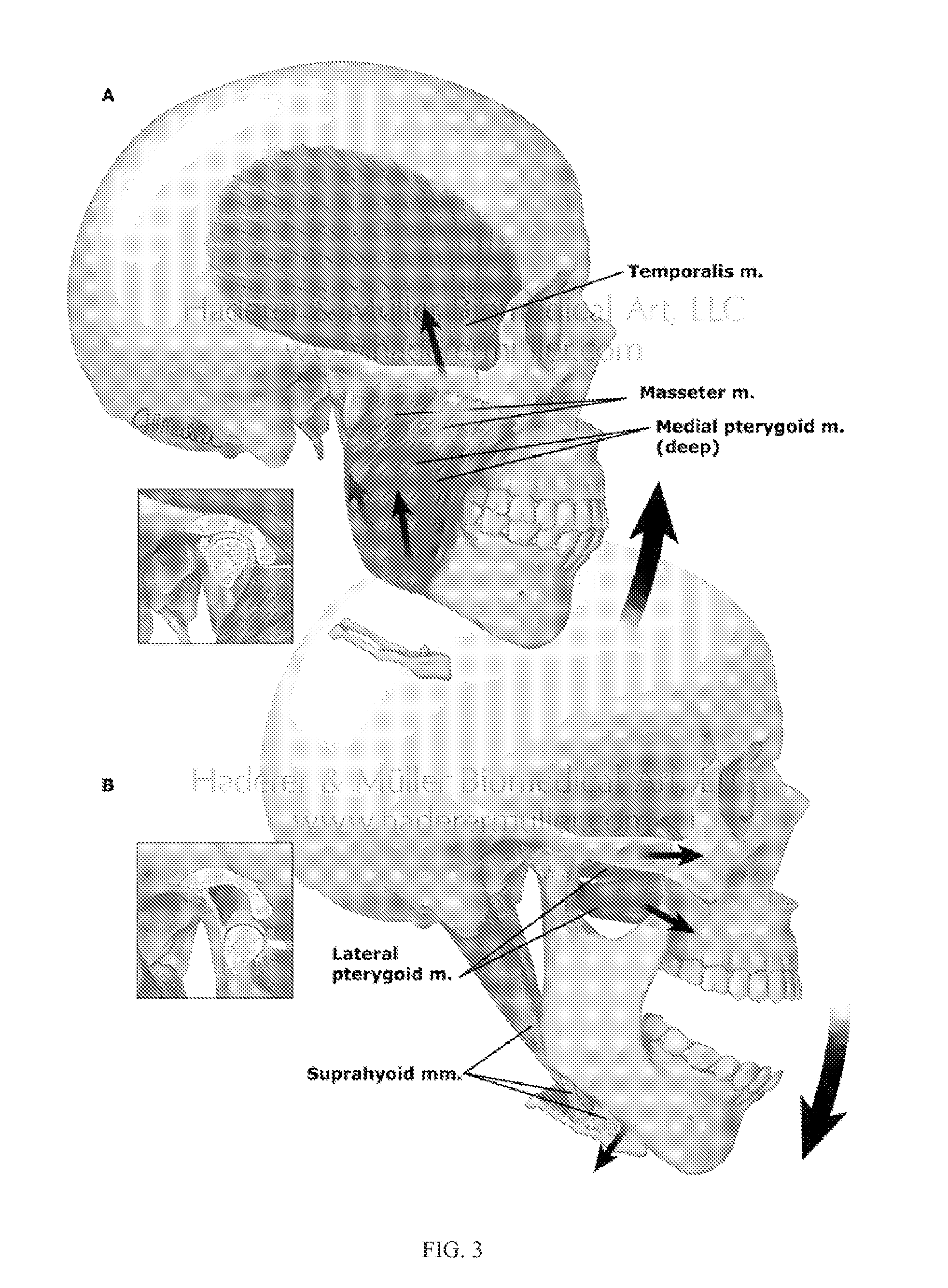 Methods, devices, and manufacture of the devices for musculoskeletal reconstructive surgery