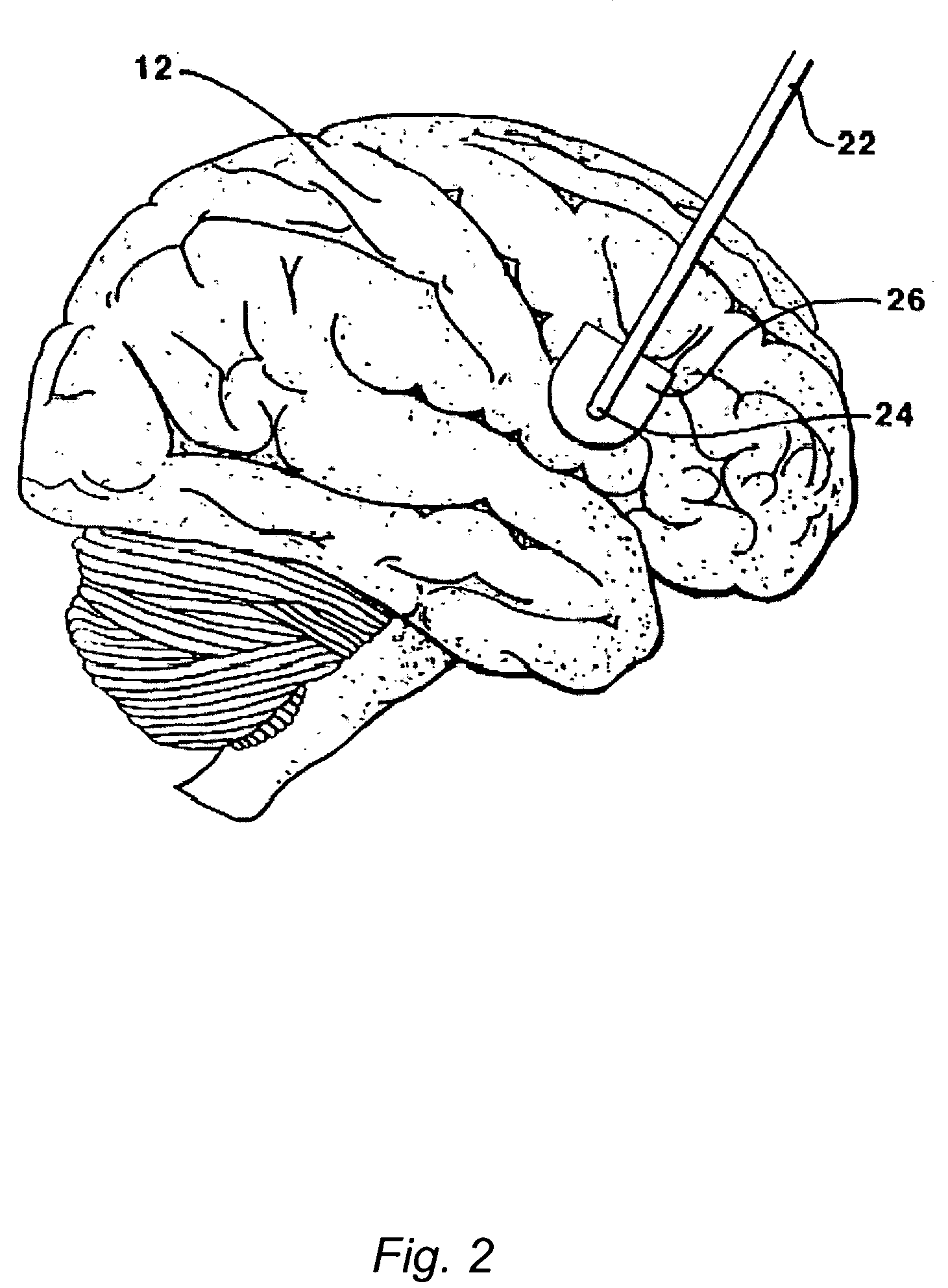 Methods and systems for treatment of neurological diseases of the central nervous system
