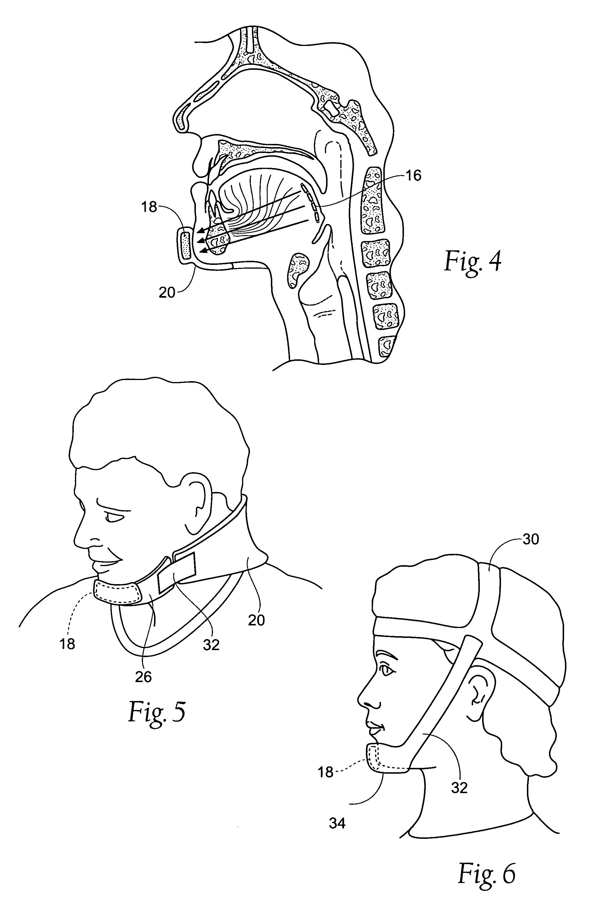 Devices, systems, and methods for stabilization or fixation of magnetic force devices used in or on a body