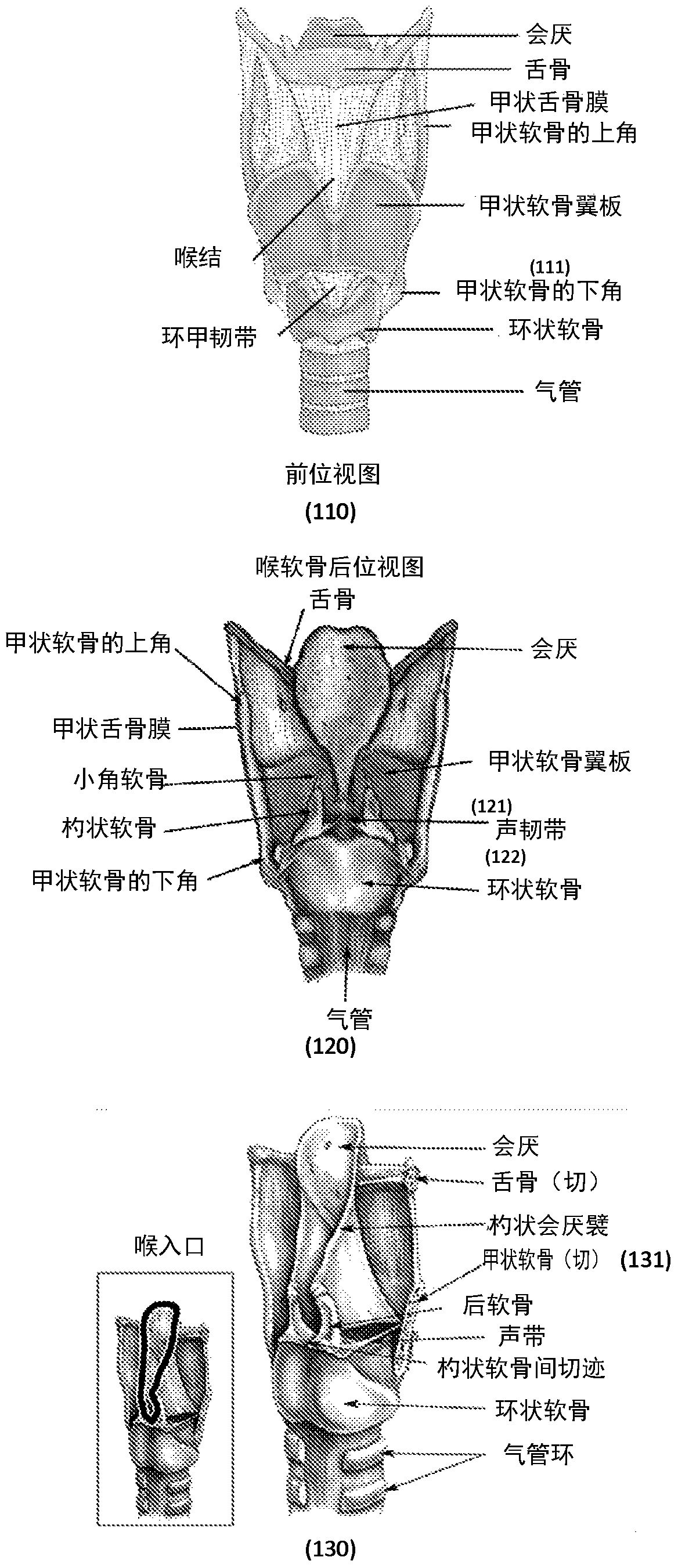 Methods and devices for treating glottic insufficiency