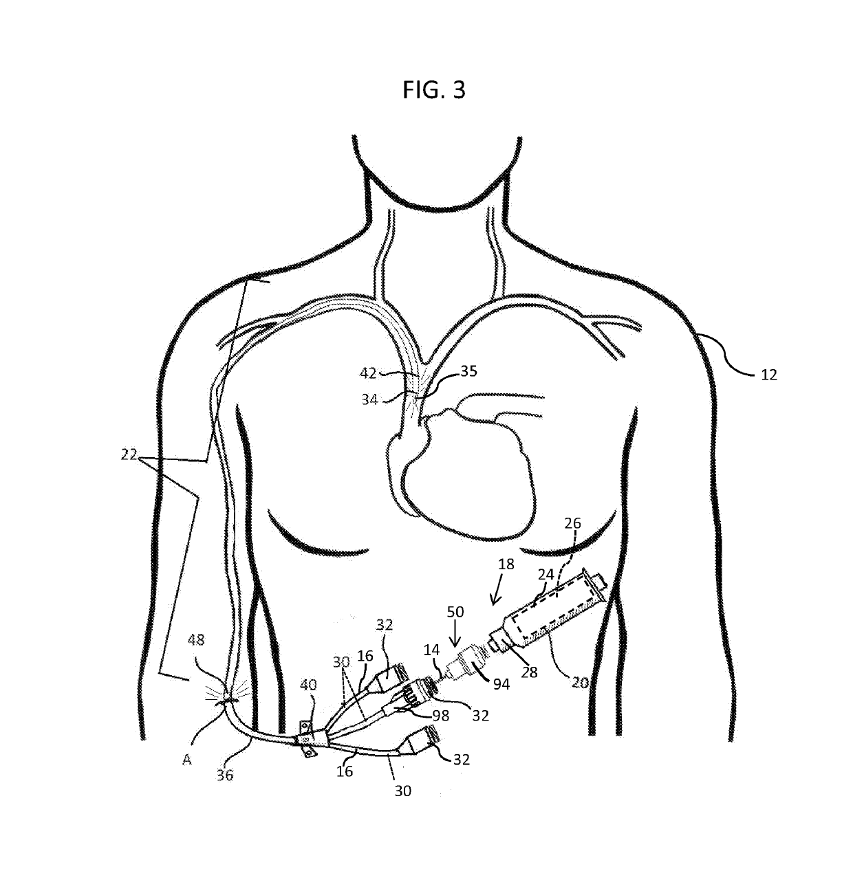 Methods and apparatus to deliver therapeutic, non-ultraviolet electromagnetic radiation to inactivate infectious agents and/or to enhance healthy cell growth via a catheter residing in a body cavity