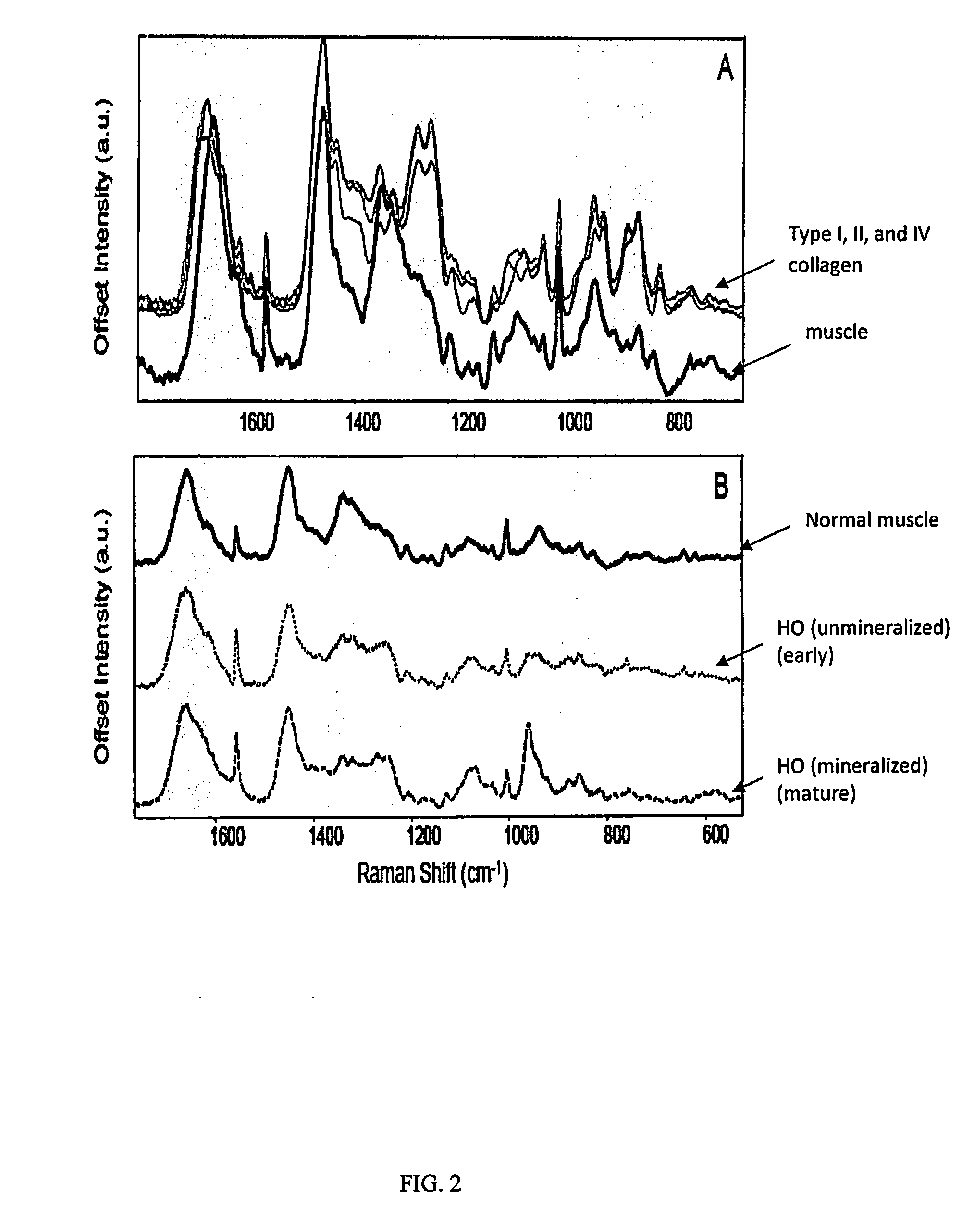 Method for the analysis of progression of heterotopic ossification by Raman spectroscopy