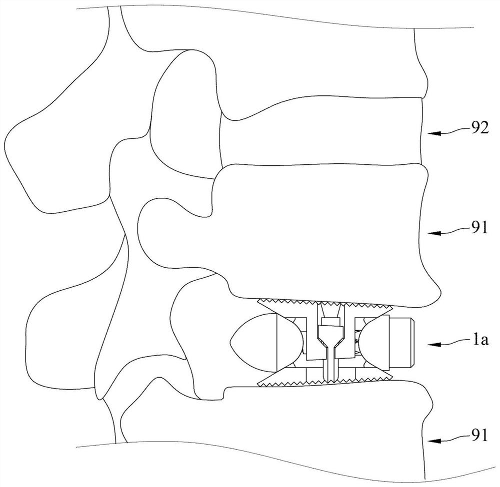 Spinal intervertebral body fusion device