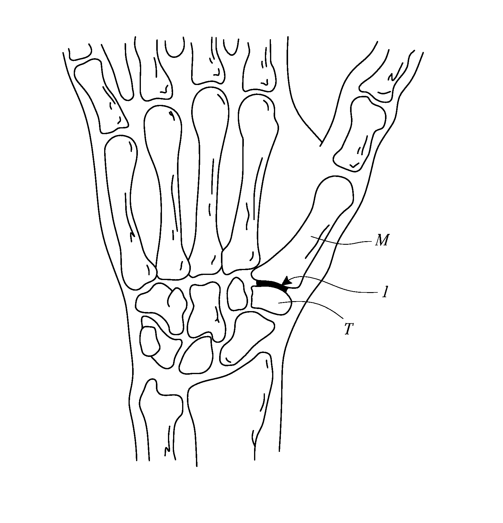 Trapeziometacarpal joint implant and associated methods