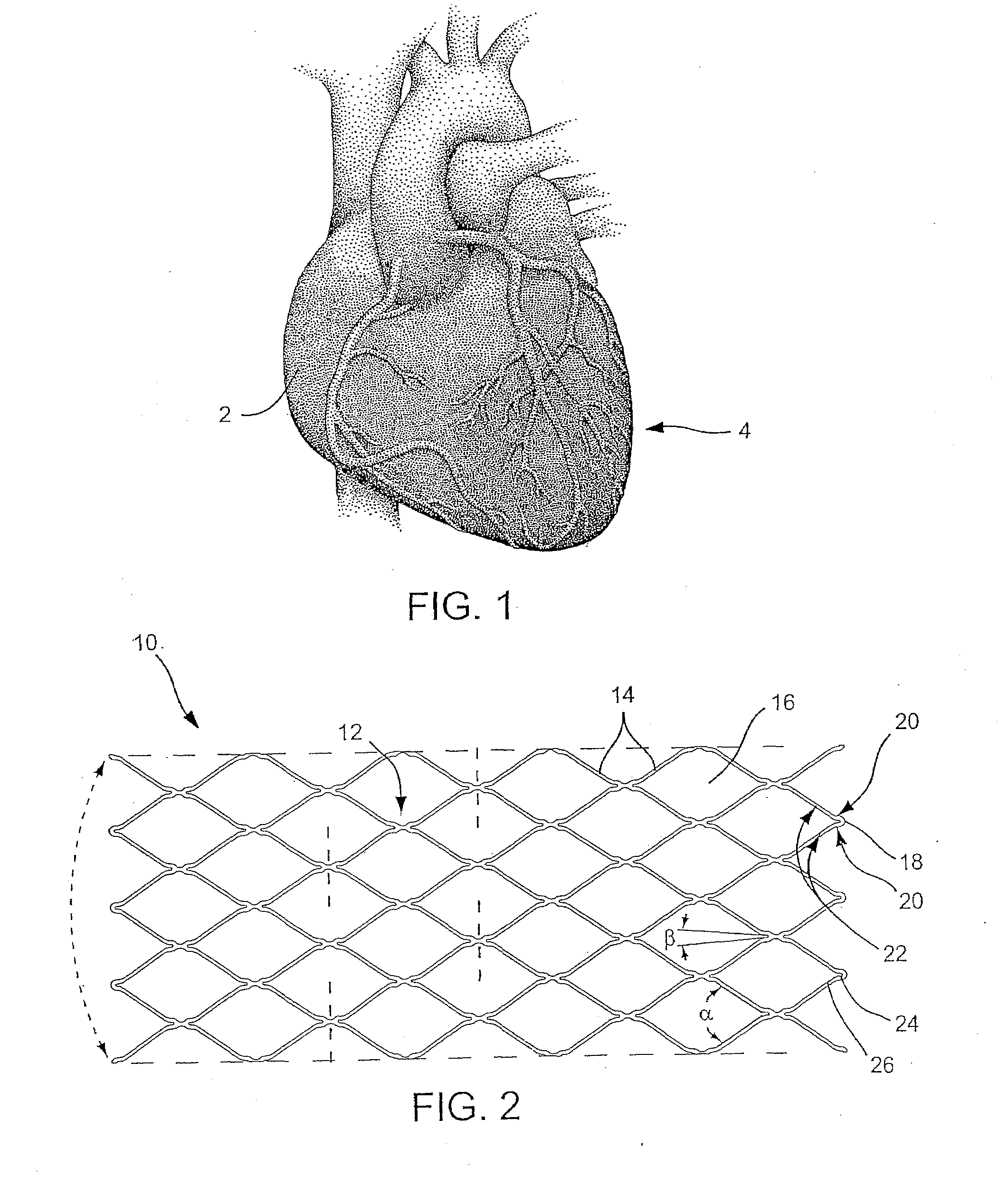 Sliding restraint stent delivery systems