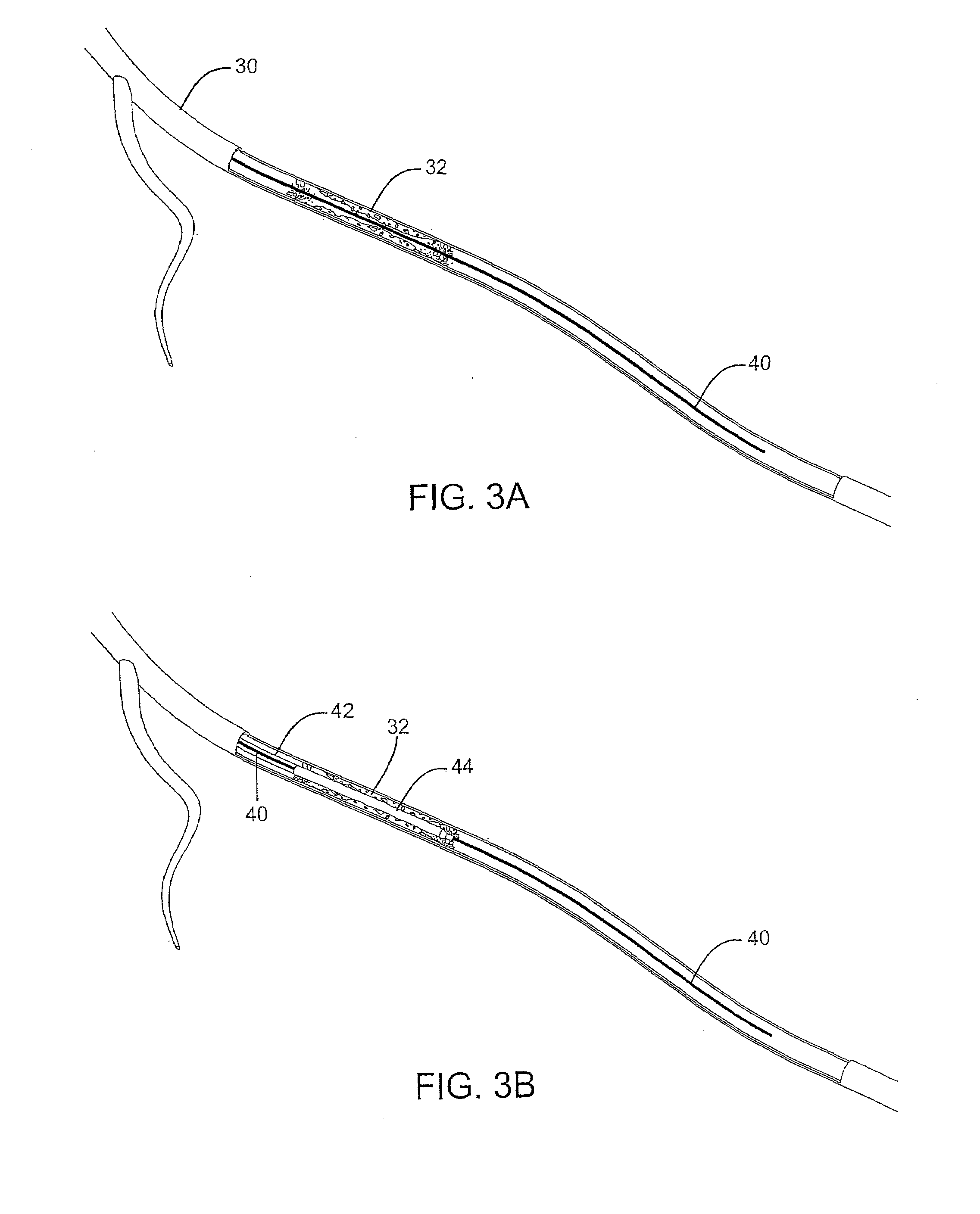 Sliding restraint stent delivery systems