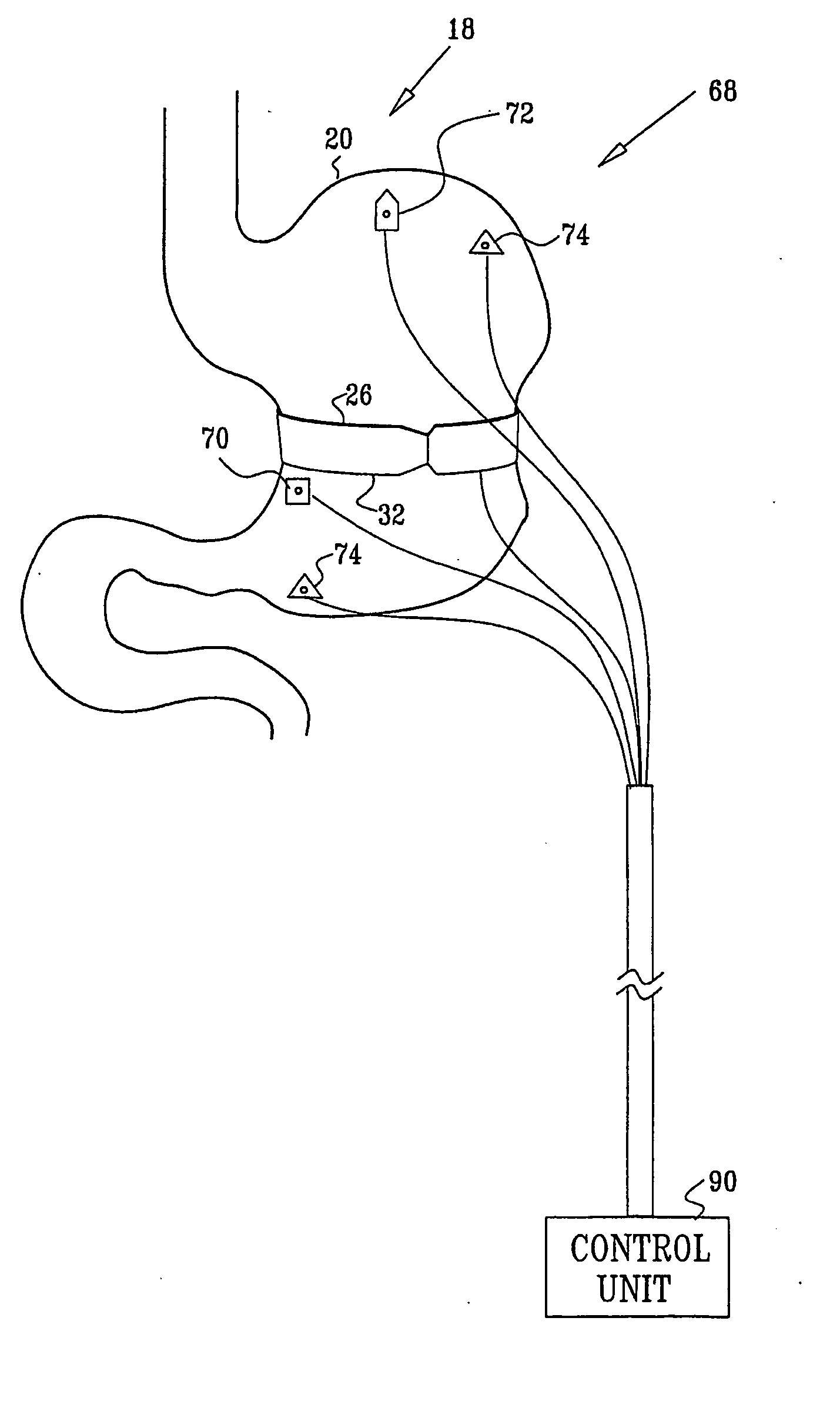 Gastrointestinal methods and apparatus for use in treating disorders and controlling blood sugar