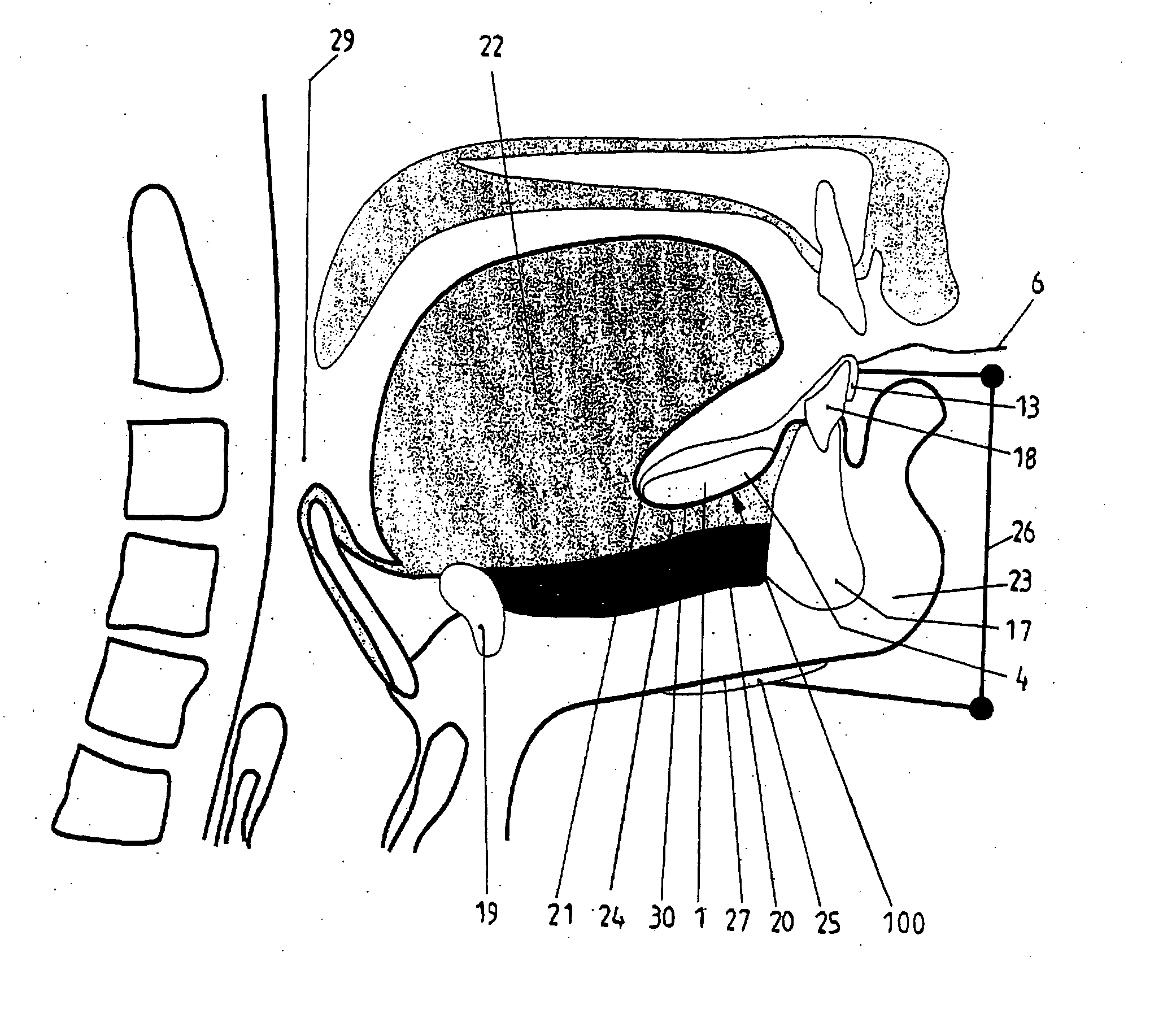 Apparatus for submental electrical stimulation of the supra hyoid muscles of the floor of mouth