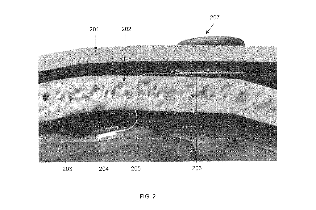 Implantable wireless neural device