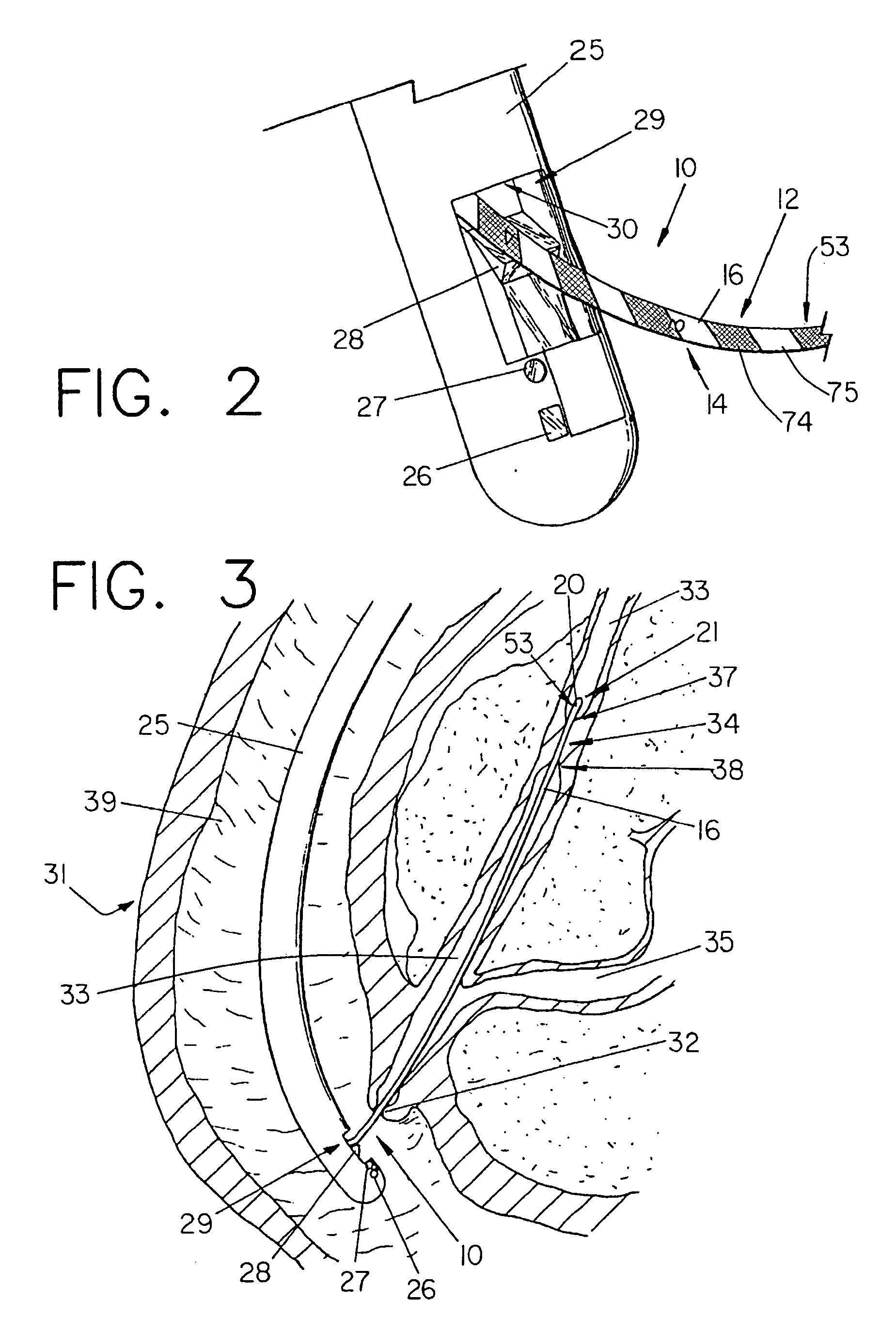 Minimally invasive medical device with helical pattern for indicating distance of movement