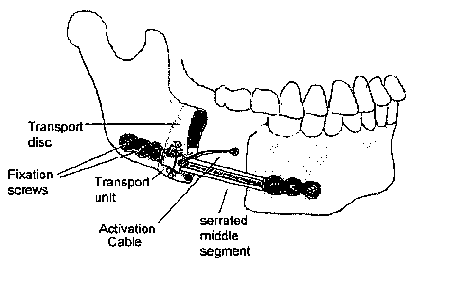 Mandibular bone transport reconstruction plate