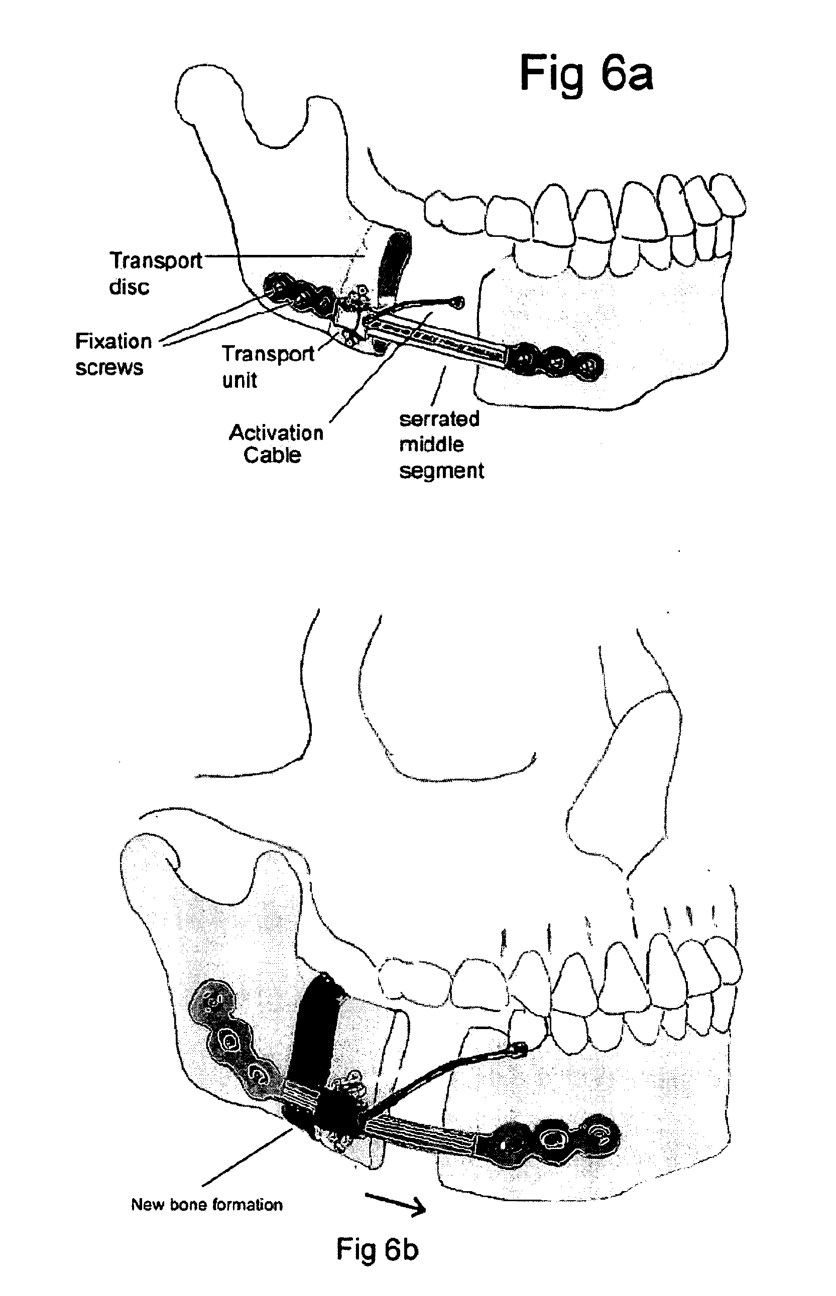 Mandibular bone transport reconstruction plate