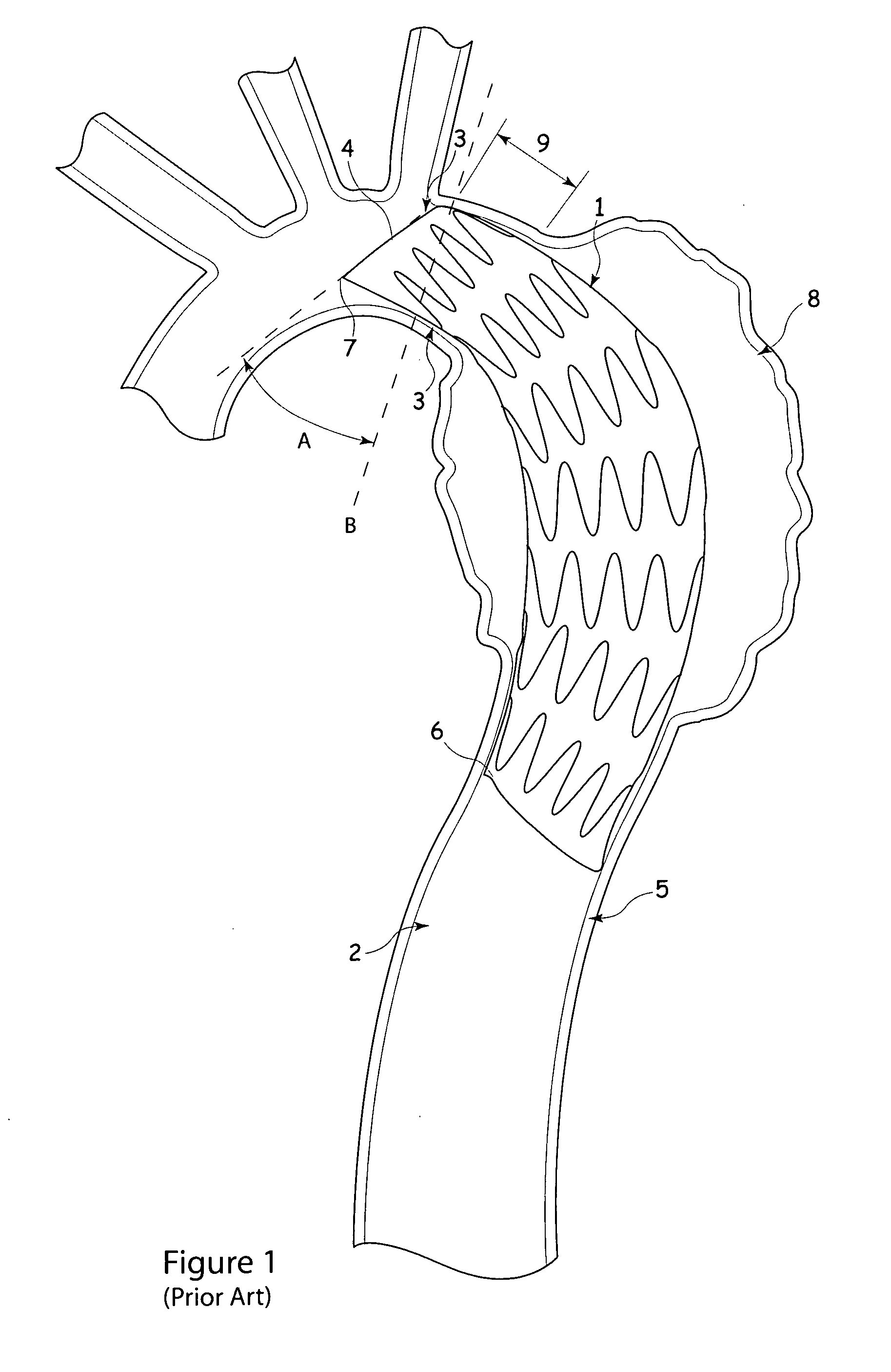 Apparatus for and method of fitting a stent-graft or similar device