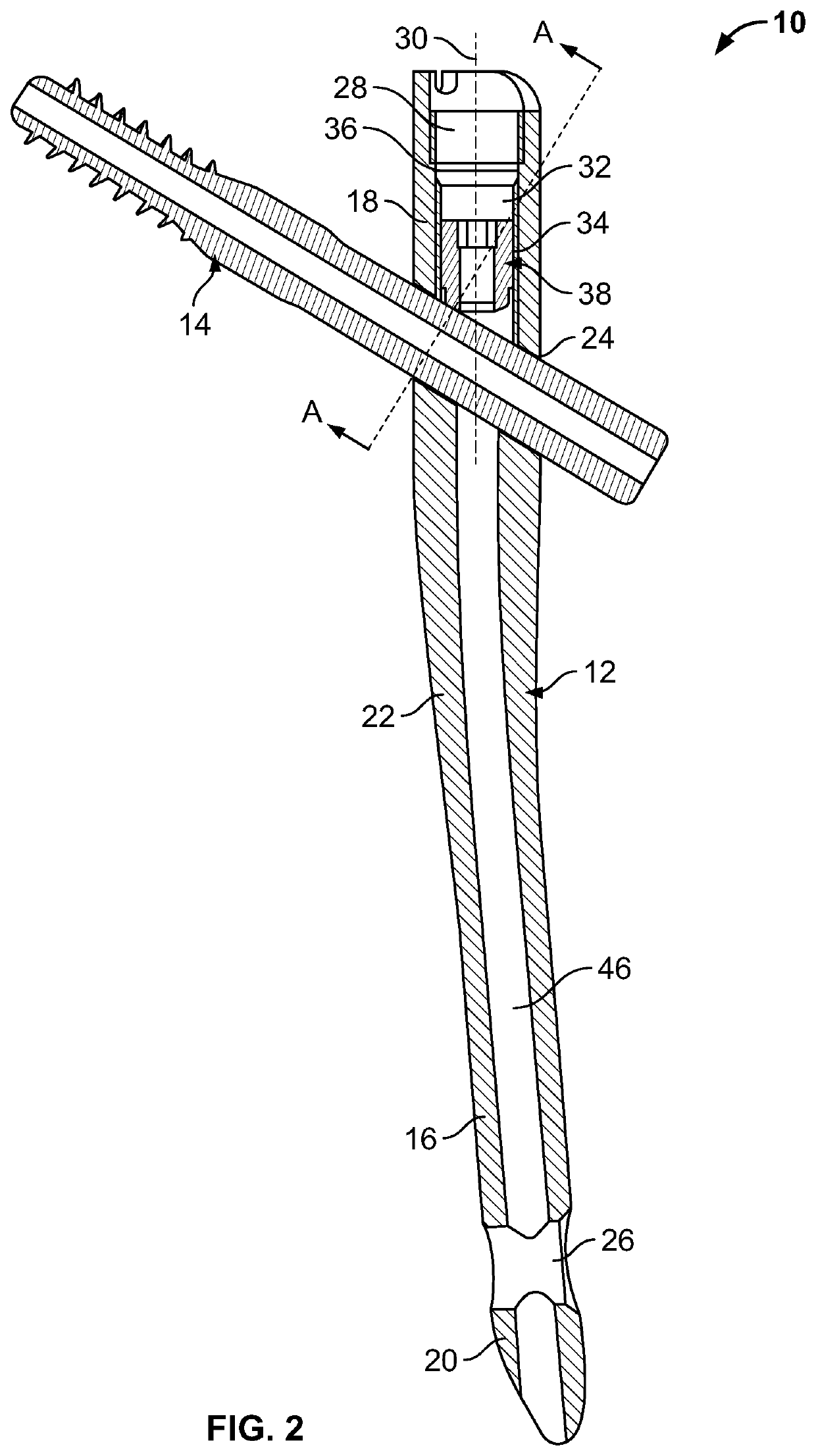 Implant System for Bone Fixation