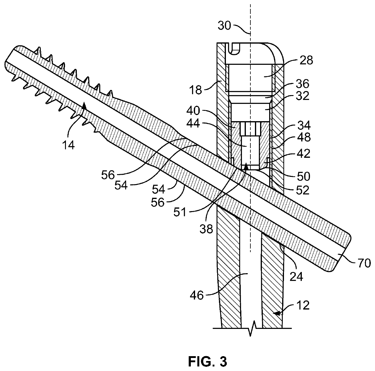 Implant System for Bone Fixation