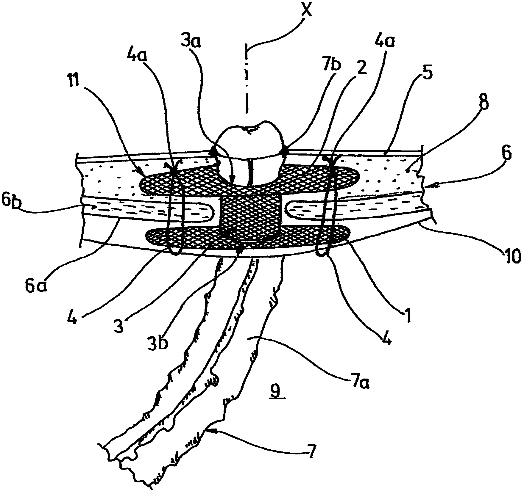 Medical device for the reconstruction of parastomal hernias and/or for the prevention of their development