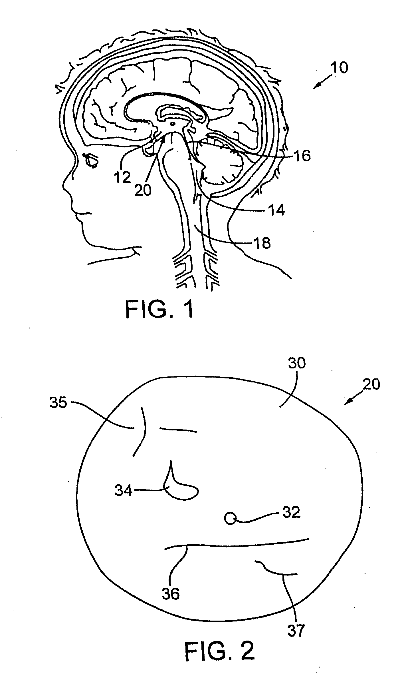 Interfacial stent and method of maintaining patency of surgical fenestrations